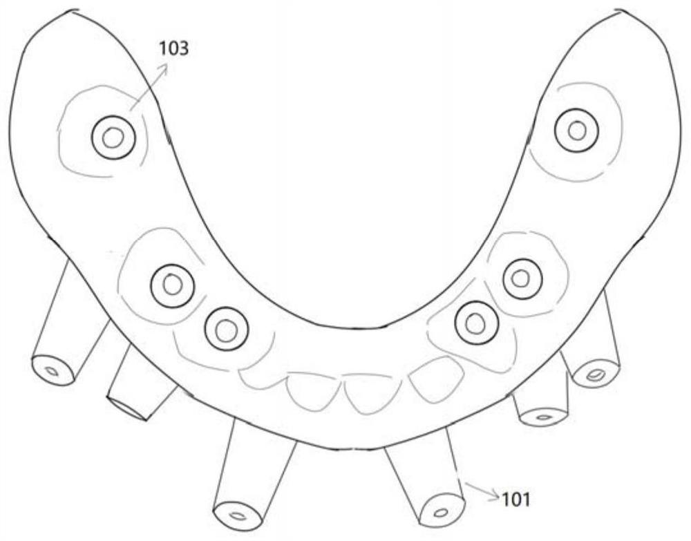 Occlusion-oriented implant surgery device for missing dentition and preparation method thereof