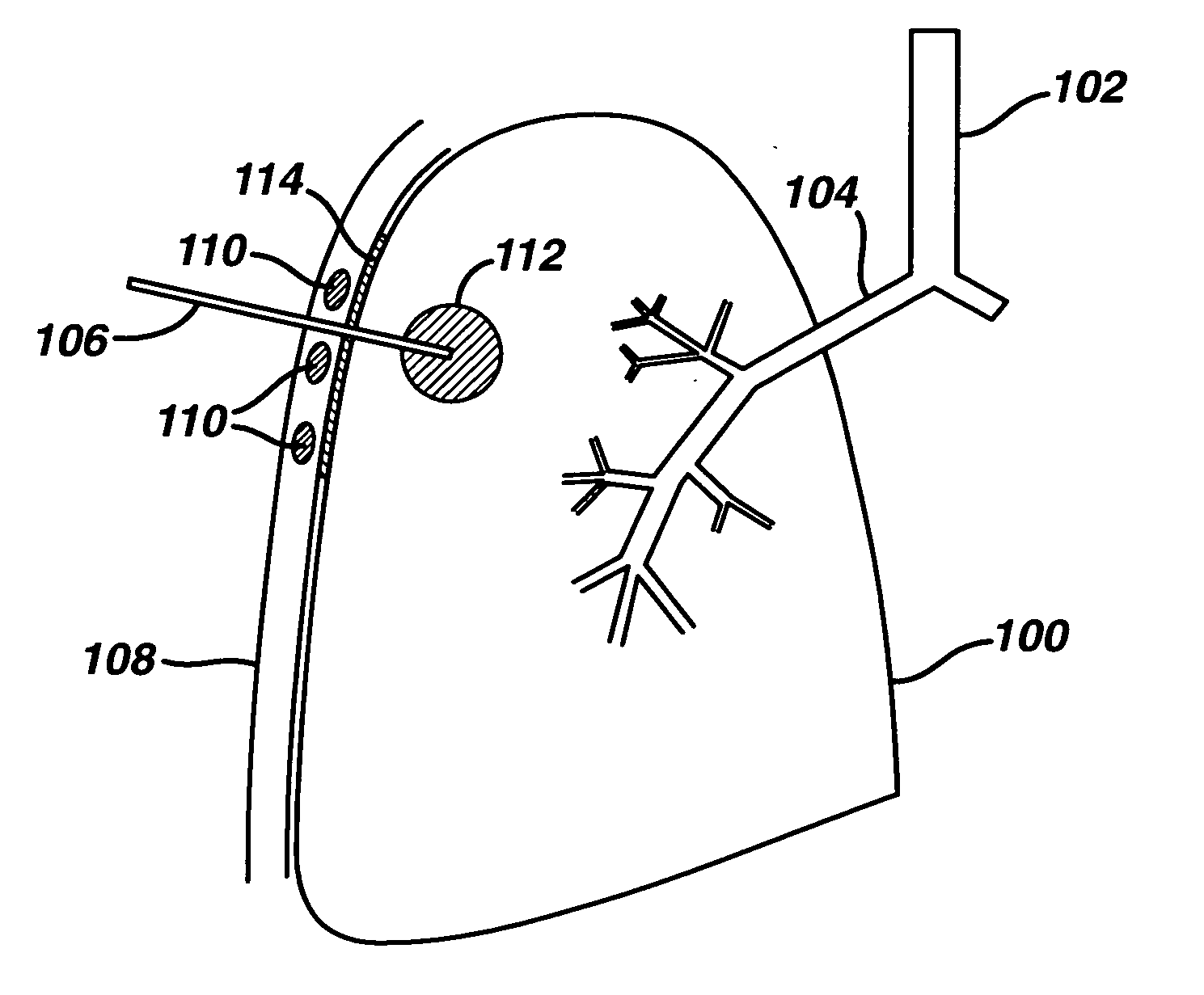 Pulmonary drug delivery