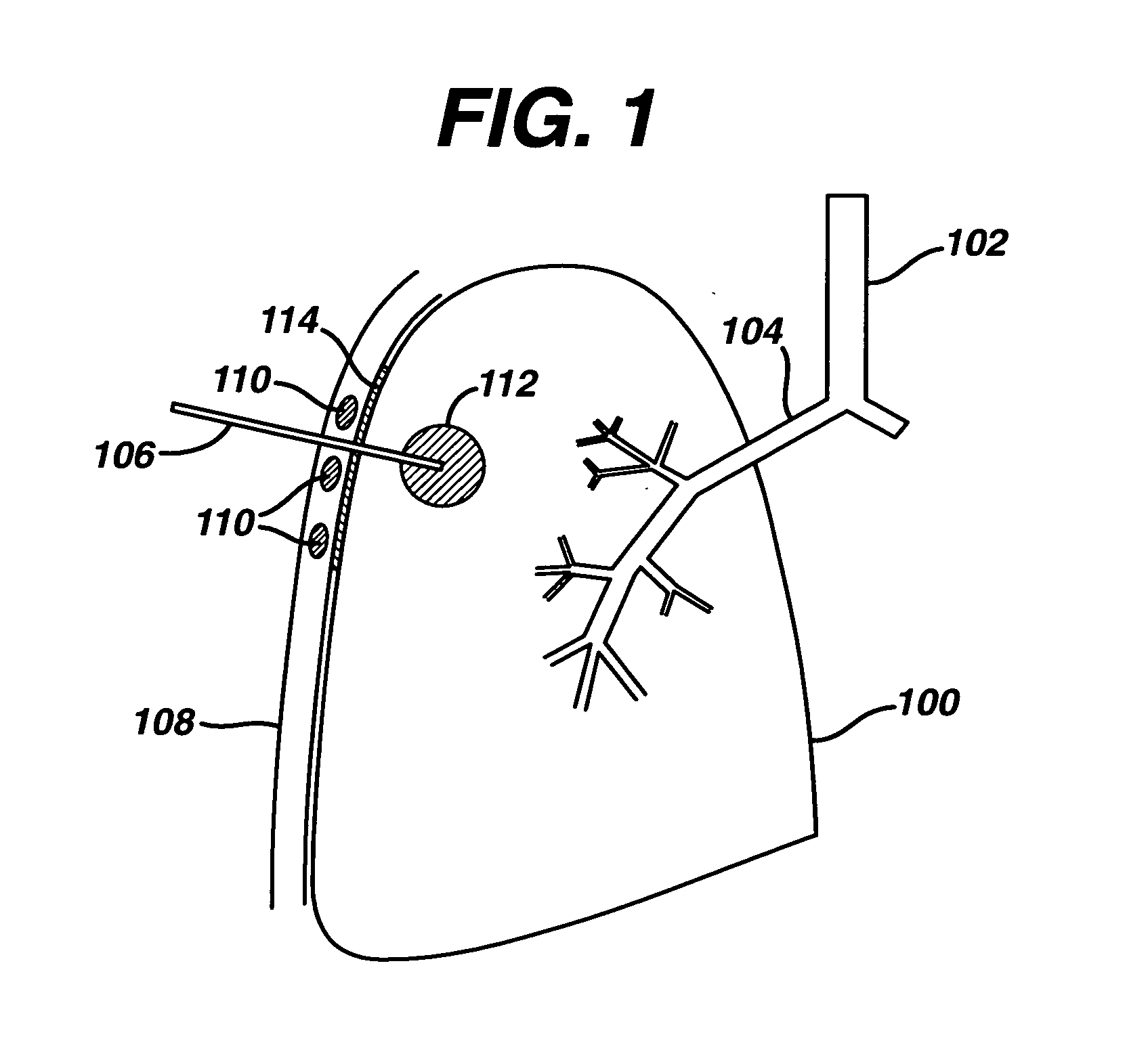 Pulmonary drug delivery