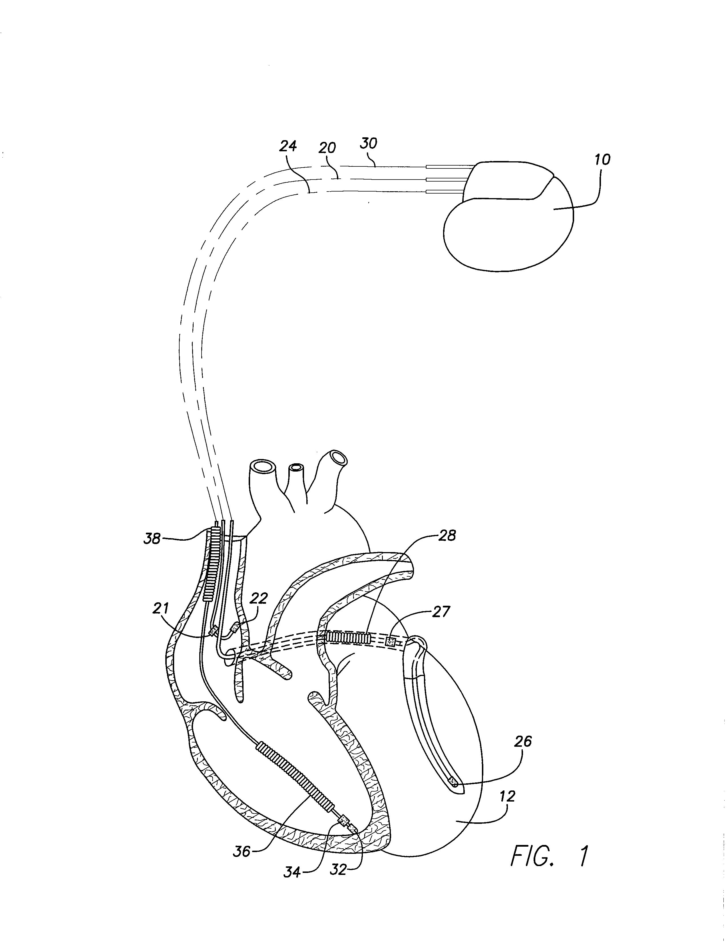 Implantable cardiac device providing intrinsic conduction search with premature atrial contraction protection and method