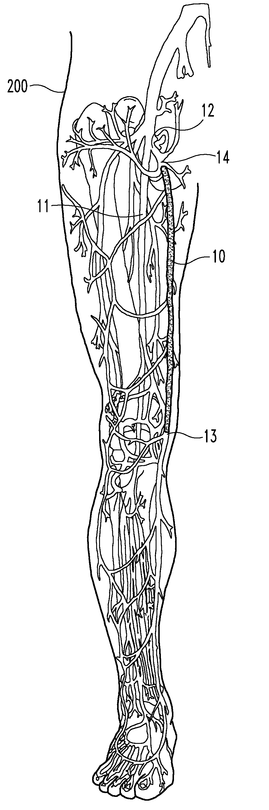 Enhanced remodelable materials for occluding bodily vessels