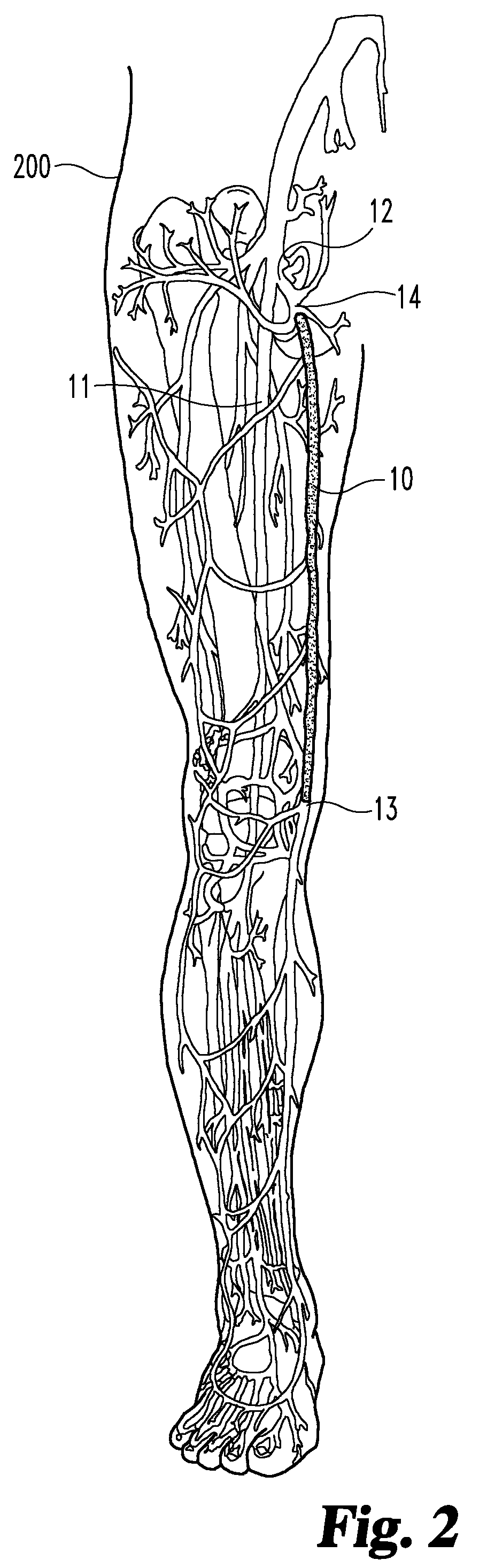 Enhanced remodelable materials for occluding bodily vessels