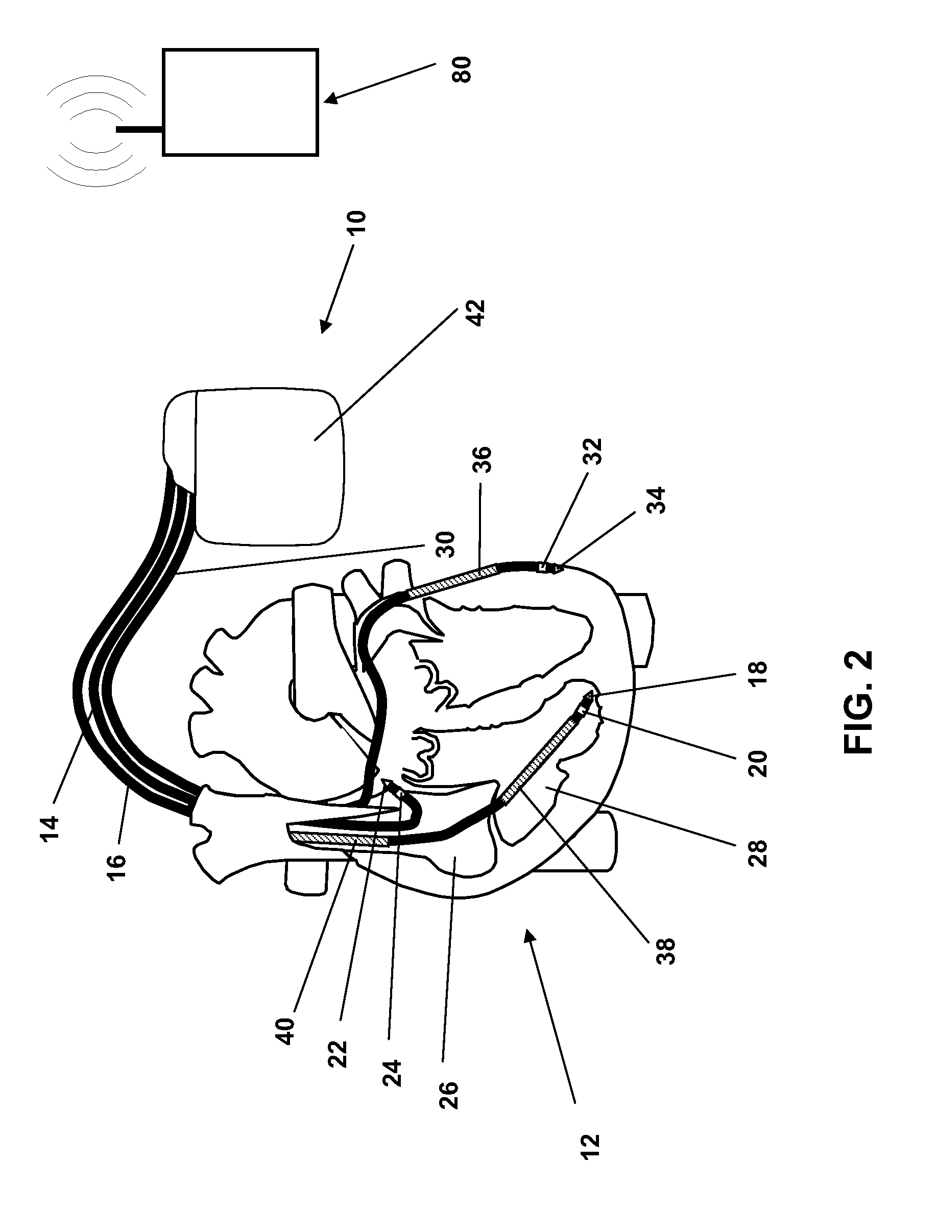 Heart monitoring system