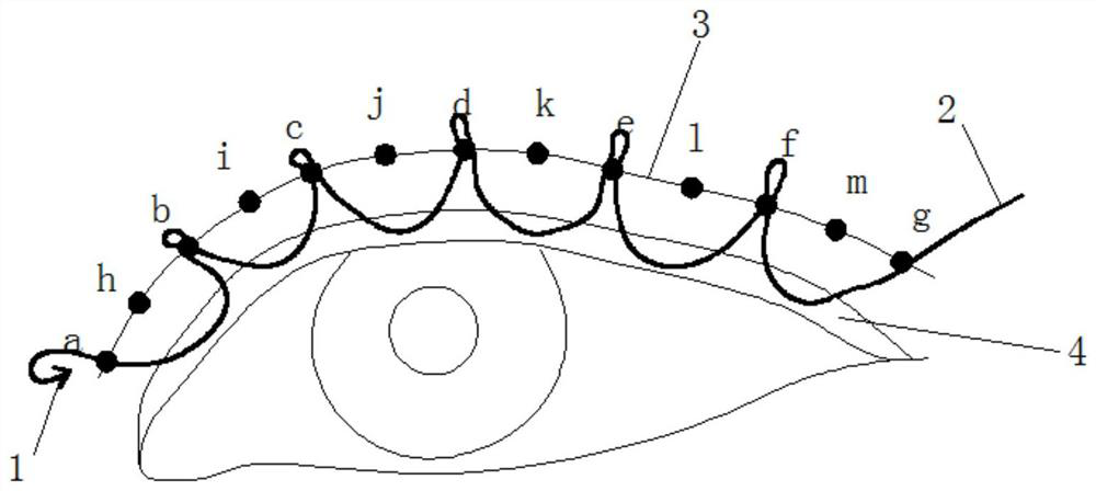 Continuous line embedding method double-fold eyelid surgery technology