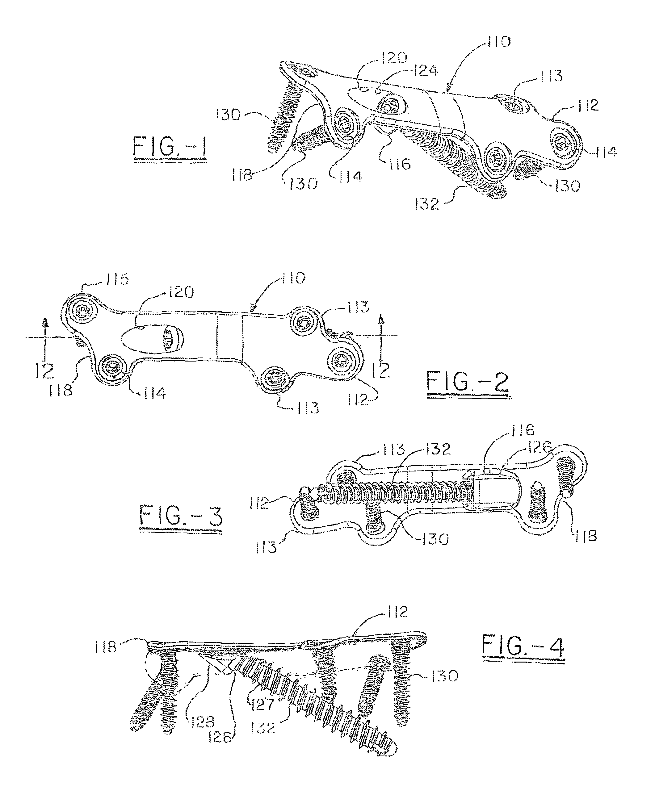 Orthopedic compression plate and method of surgery