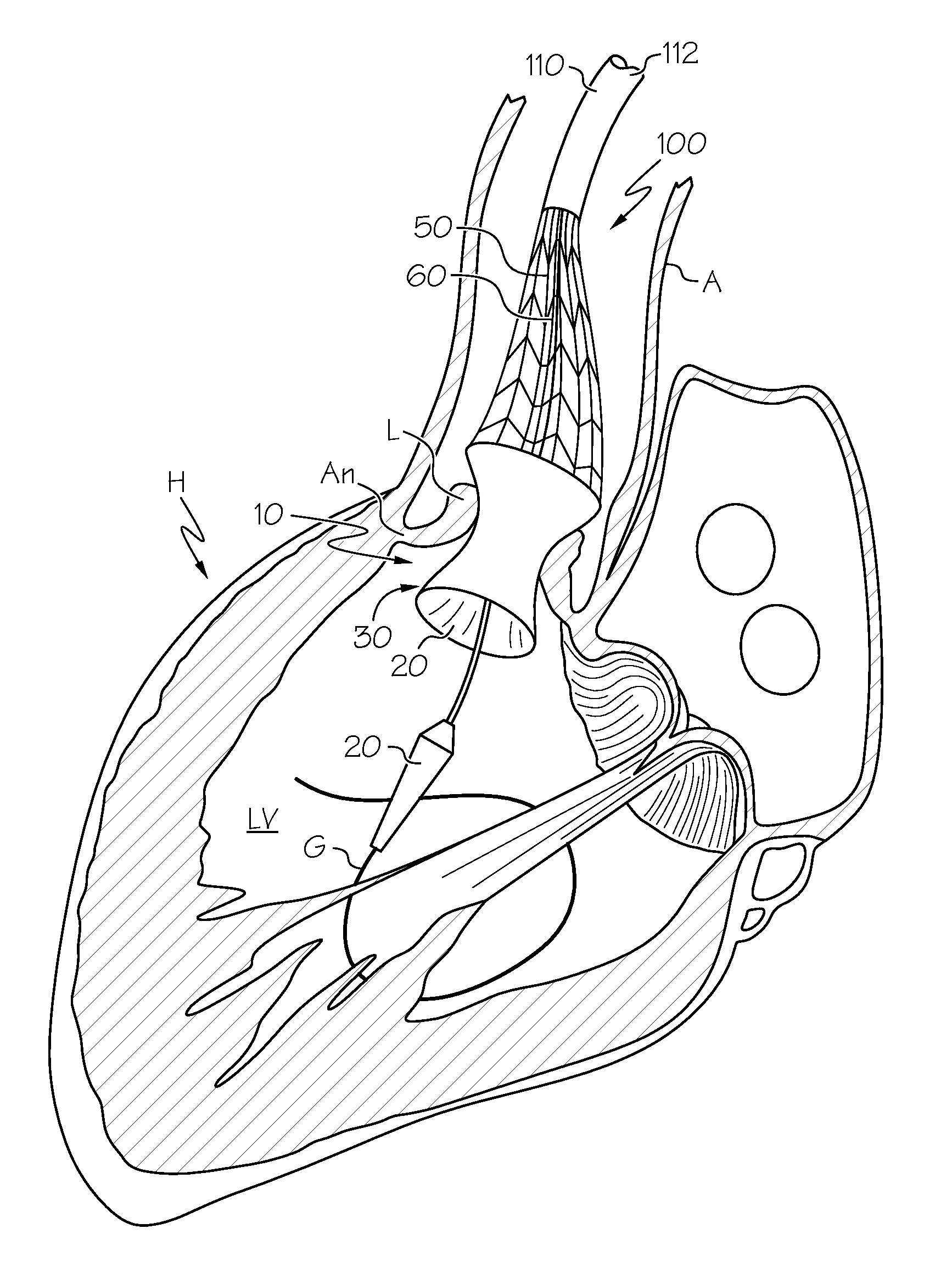 Repositionable Heart Valve and Method