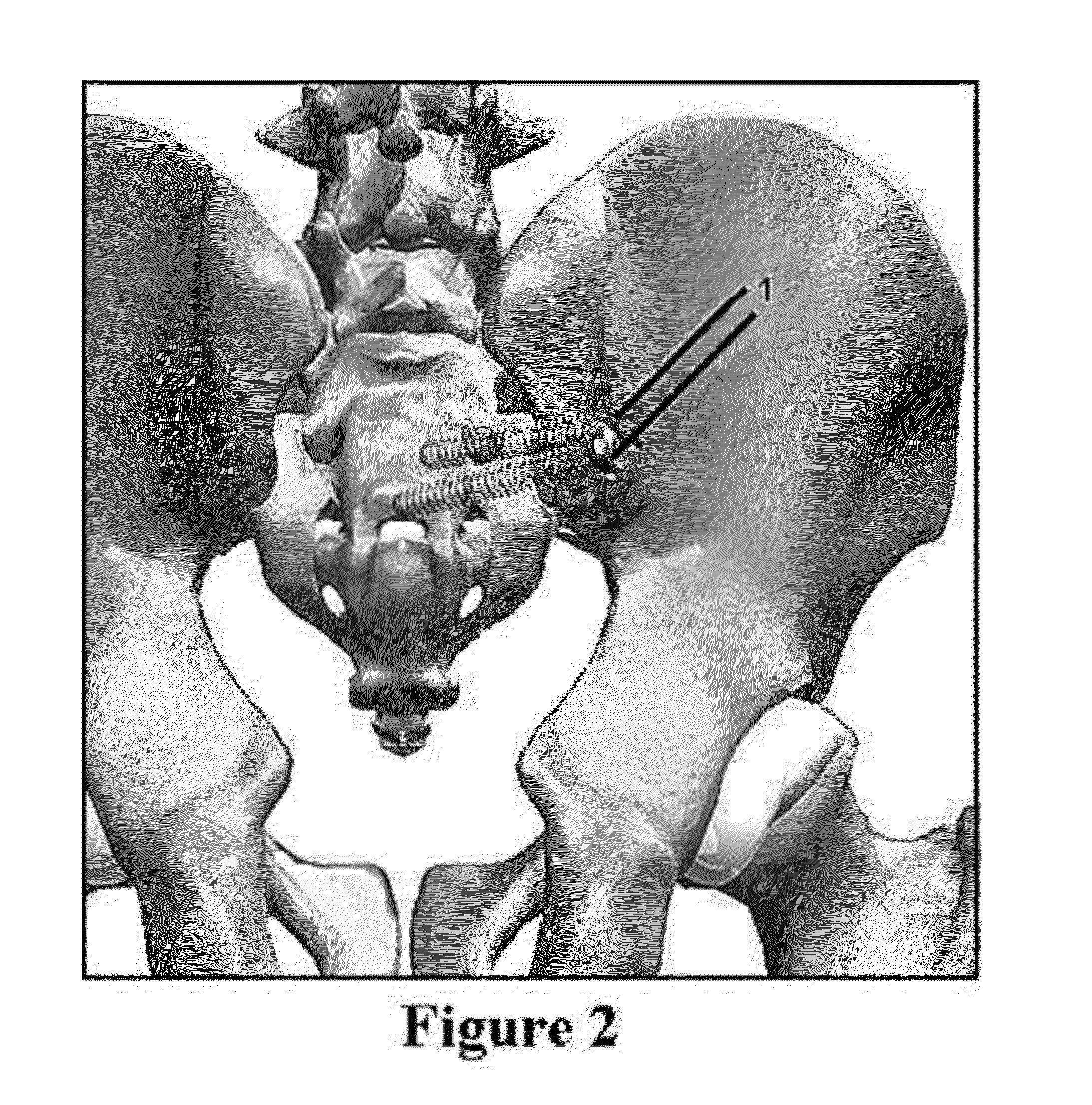 Method for Minimally Invasive Treatment of Unstable Pelvic Ring Injuries