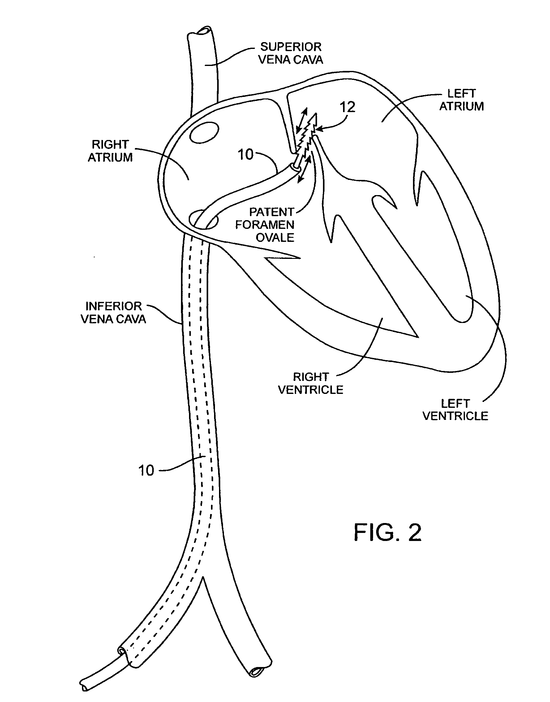 Methods and apparatus for treatment of patent foramen ovale