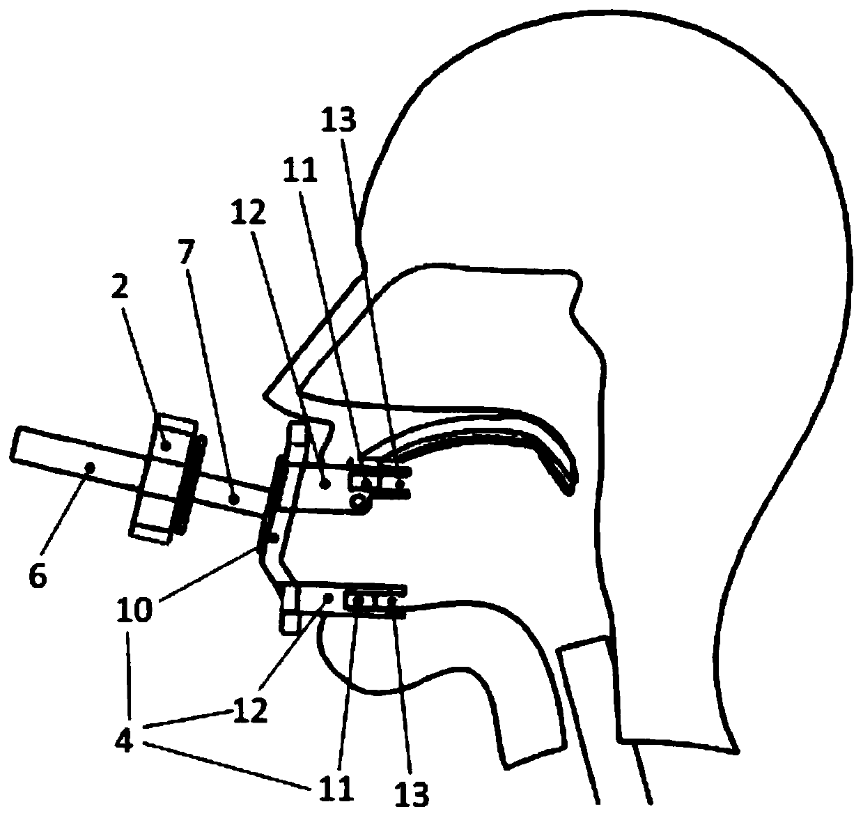 Pneumatic catheter feeding device for remotely operating trachea cannula