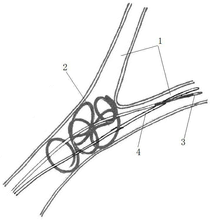 Catching device for foreign matter in blood vessel and catching method thereof