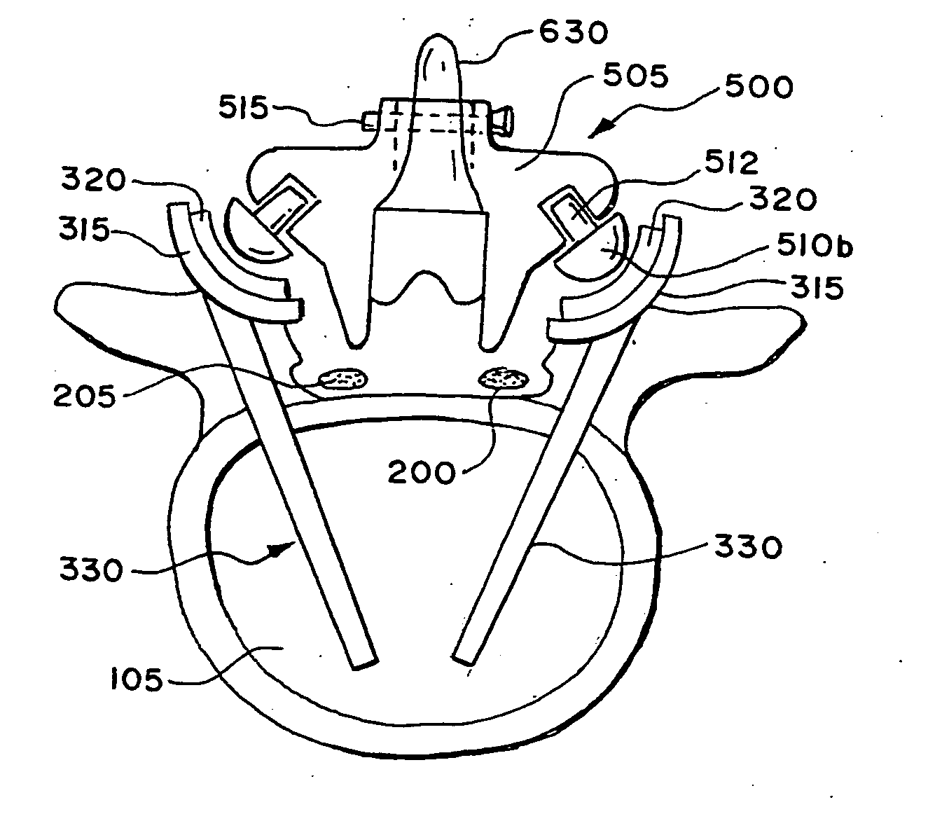 Facet arthroplasty devices and methods