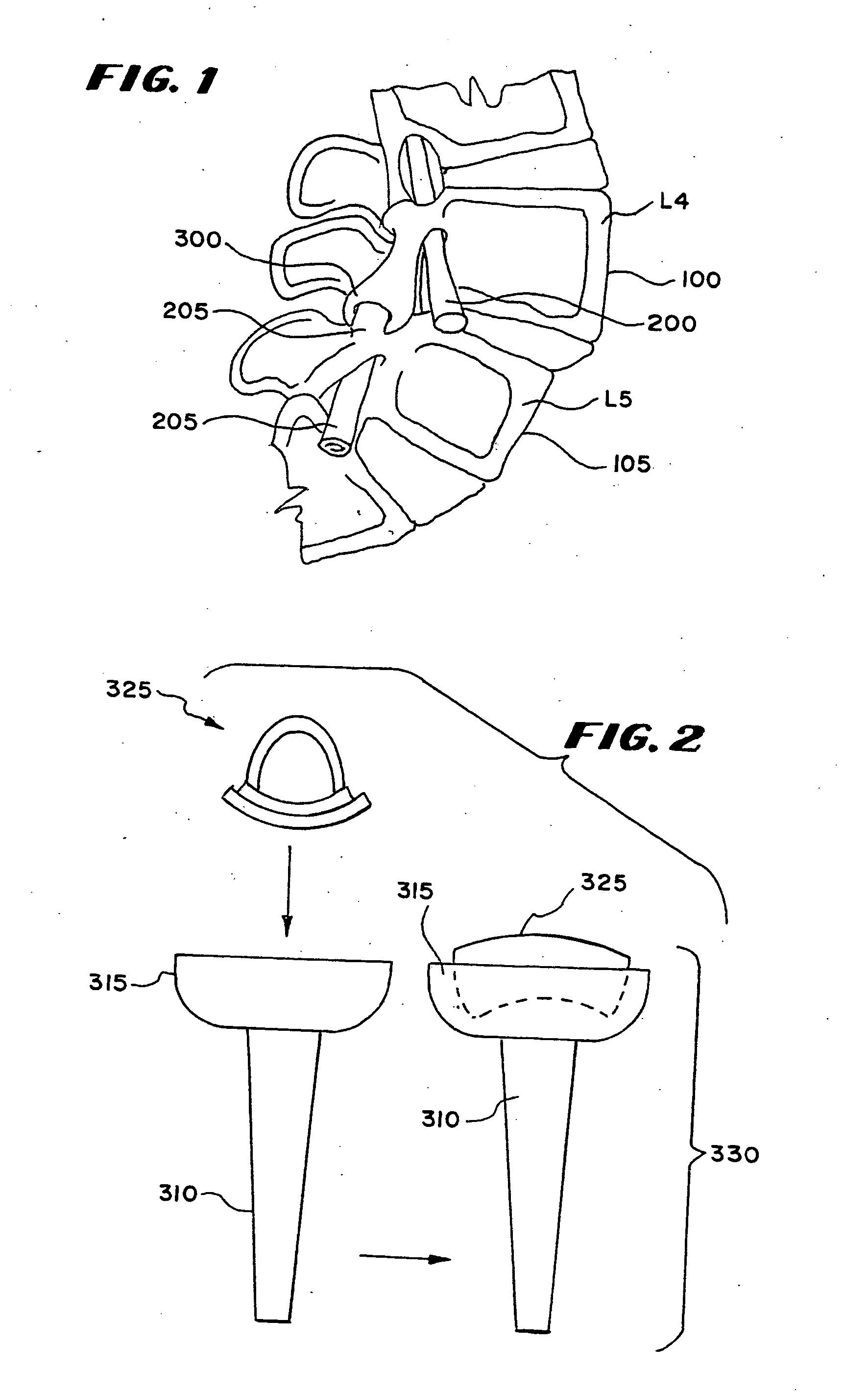 Facet arthroplasty devices and methods