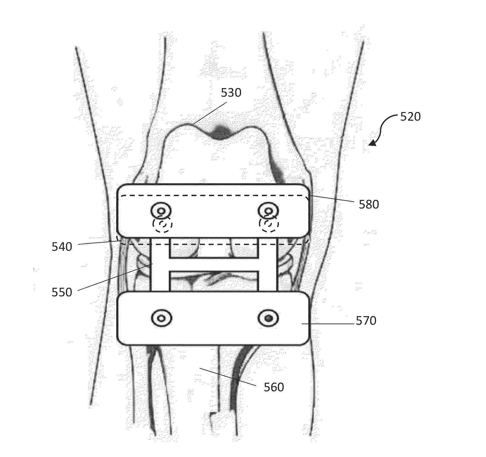 Combined Measured Resection Methods and Instruments for Knee Arthroplasty