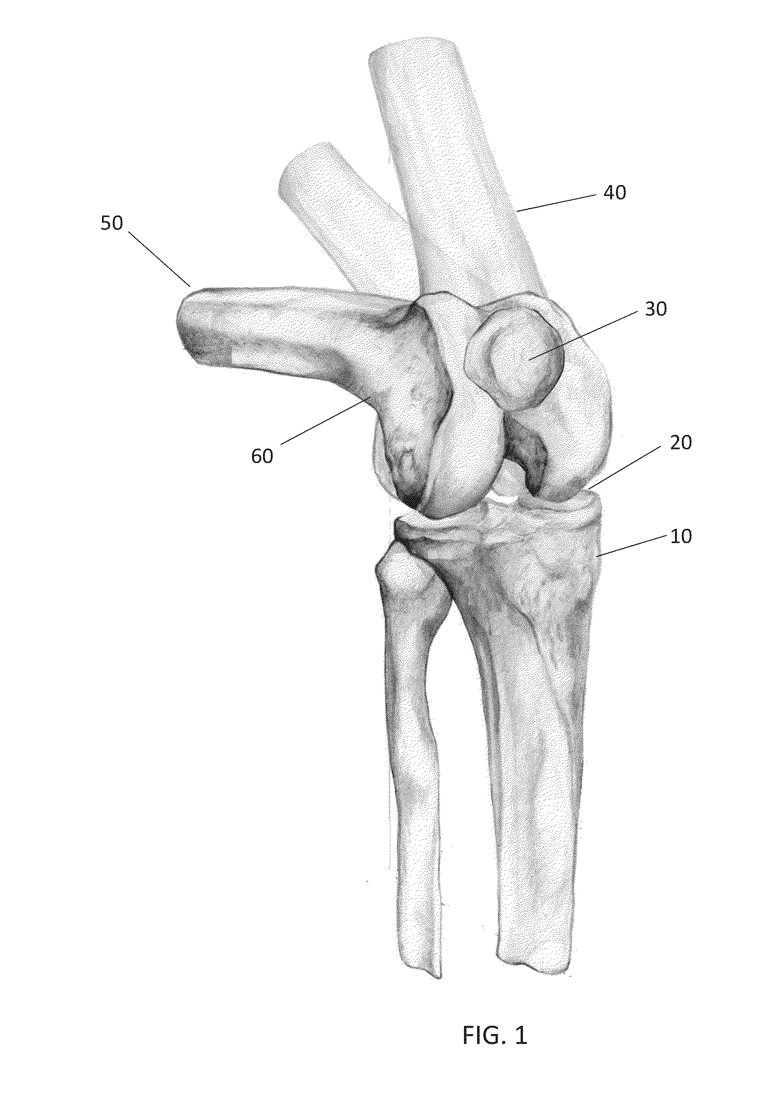 Combined Measured Resection Methods and Instruments for Knee Arthroplasty