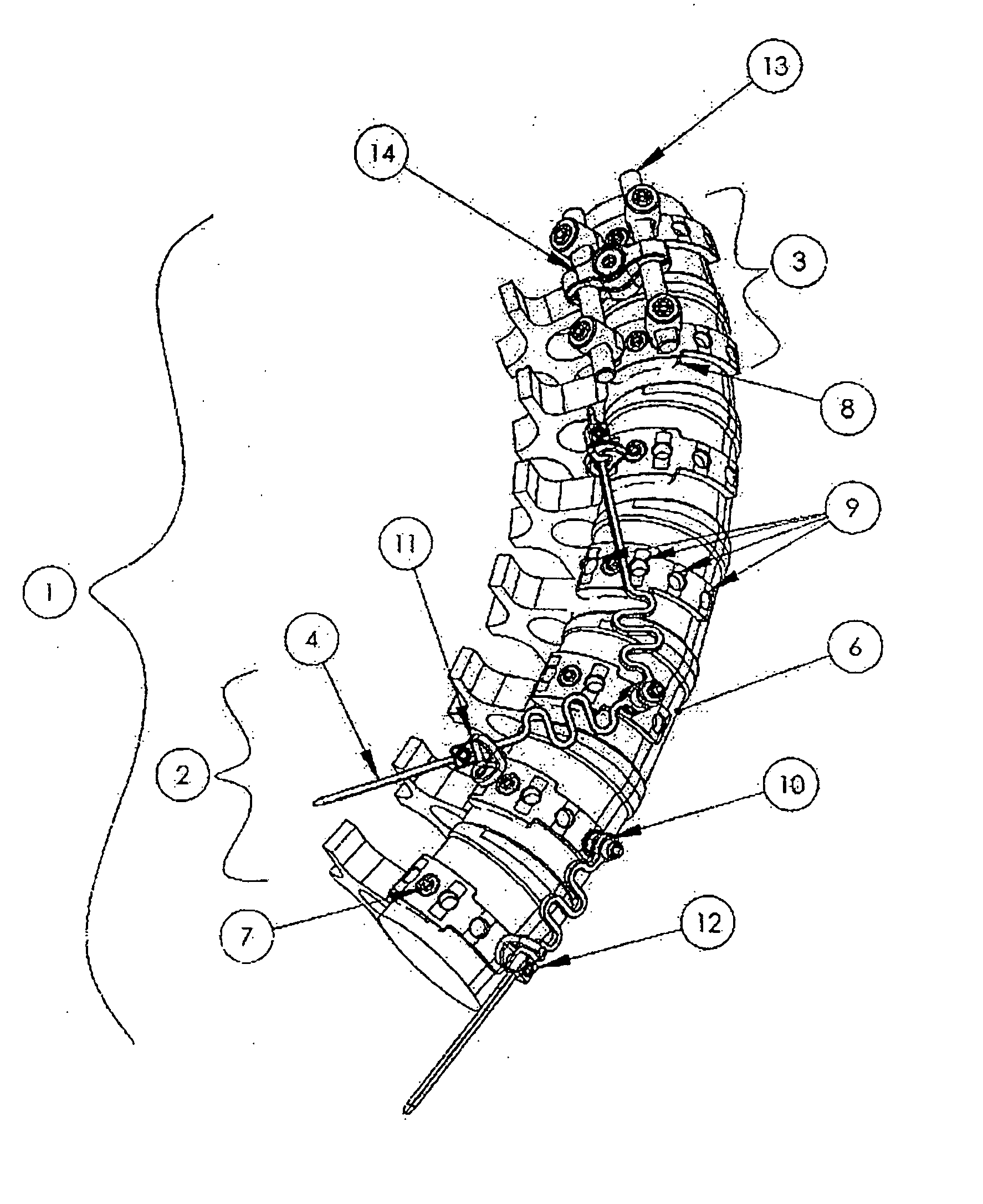 Orthopaedics device and system