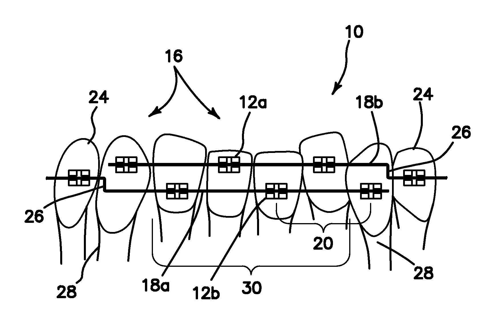 High/low bracket placements on lingual surfaces