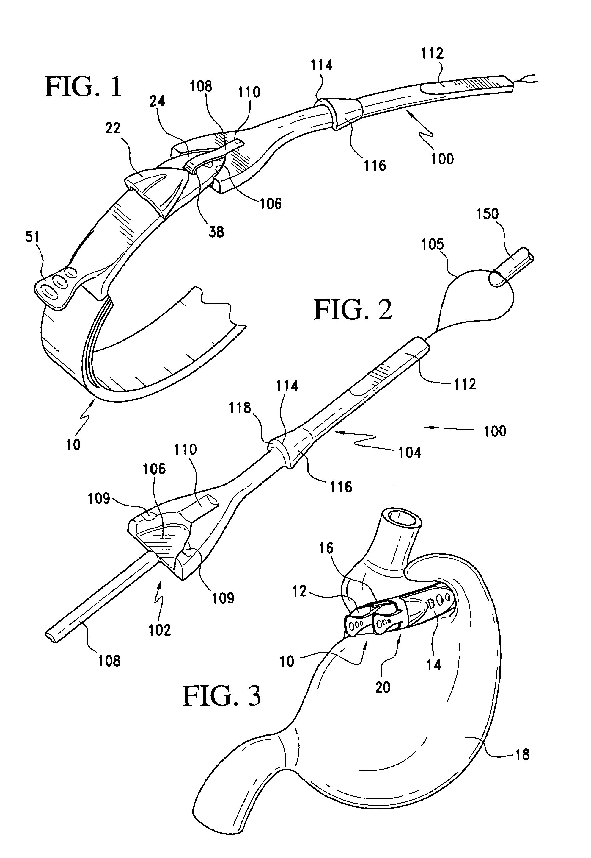 Gastric band suture tab extender