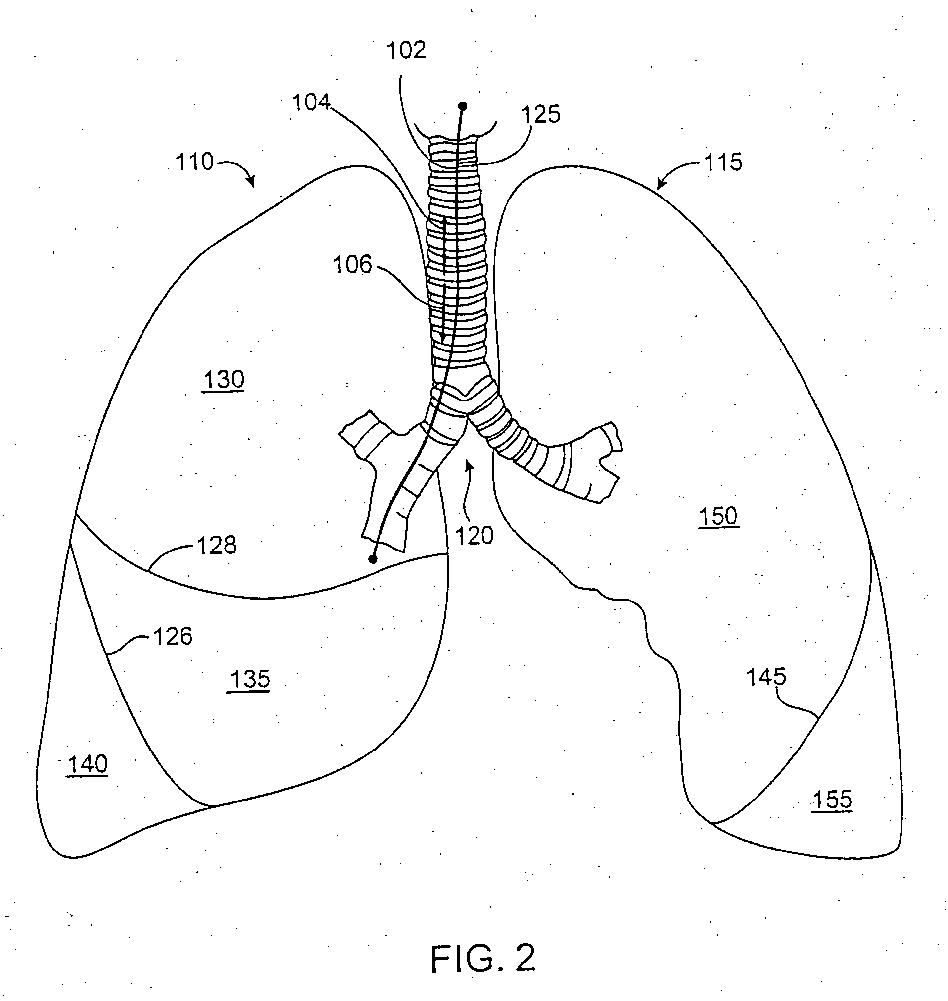 Modification of lung region flow dynamics using flow control devices implanted in bronchial wall channels