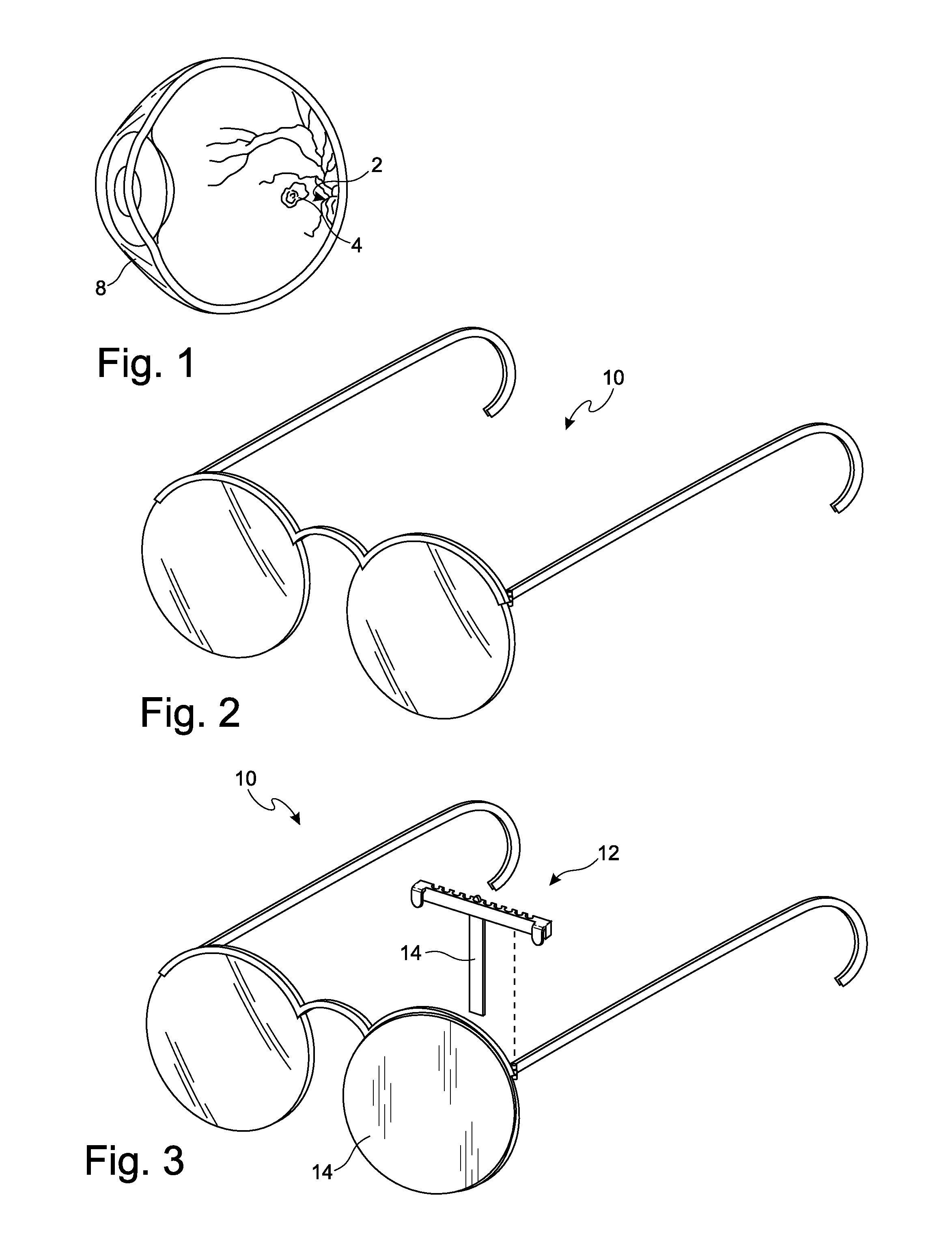 Method and devices for treatment of macular degeneration visual impairment