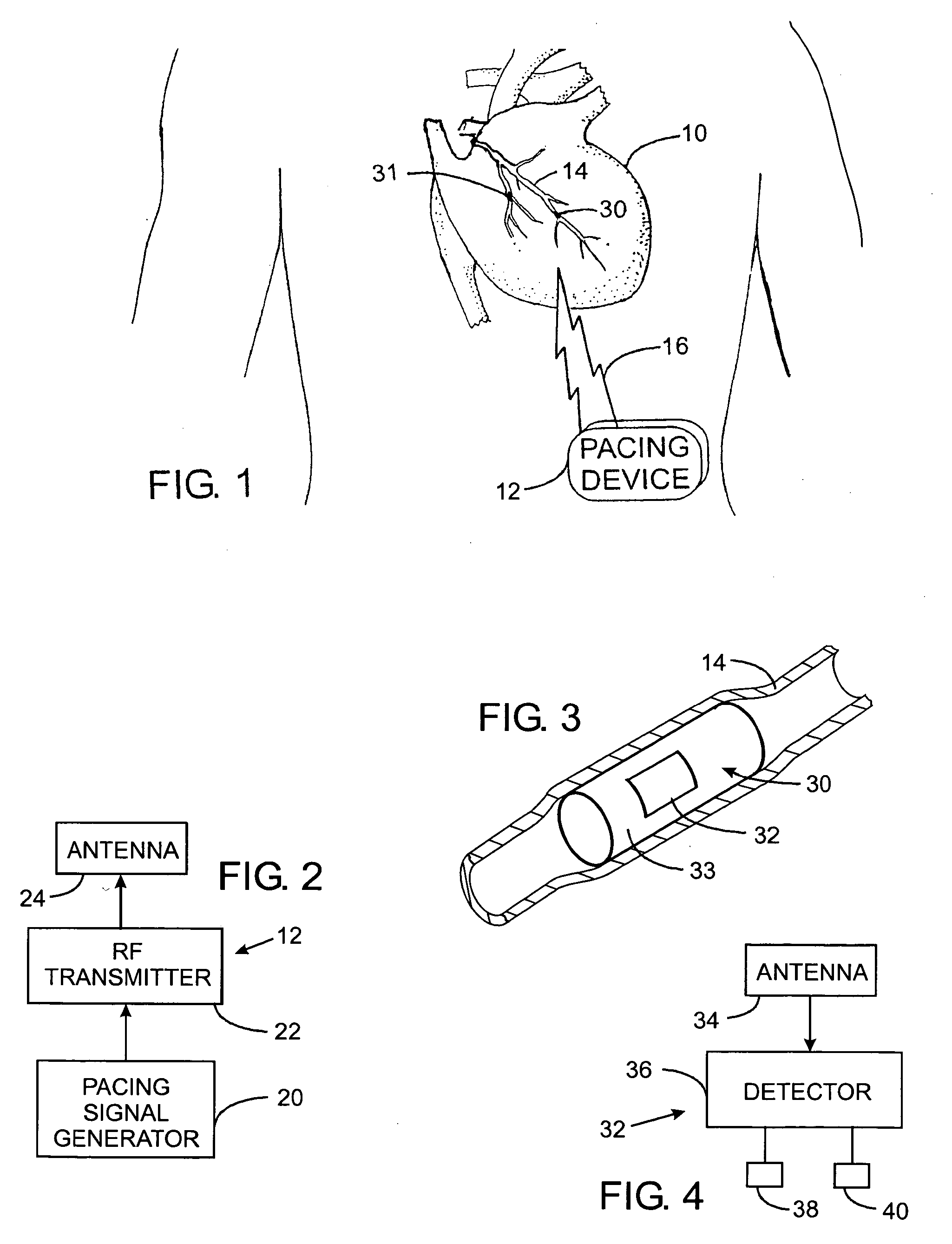 Vagal nerve stimulation using vascular implanted devices for treatment of atrial fibrillation