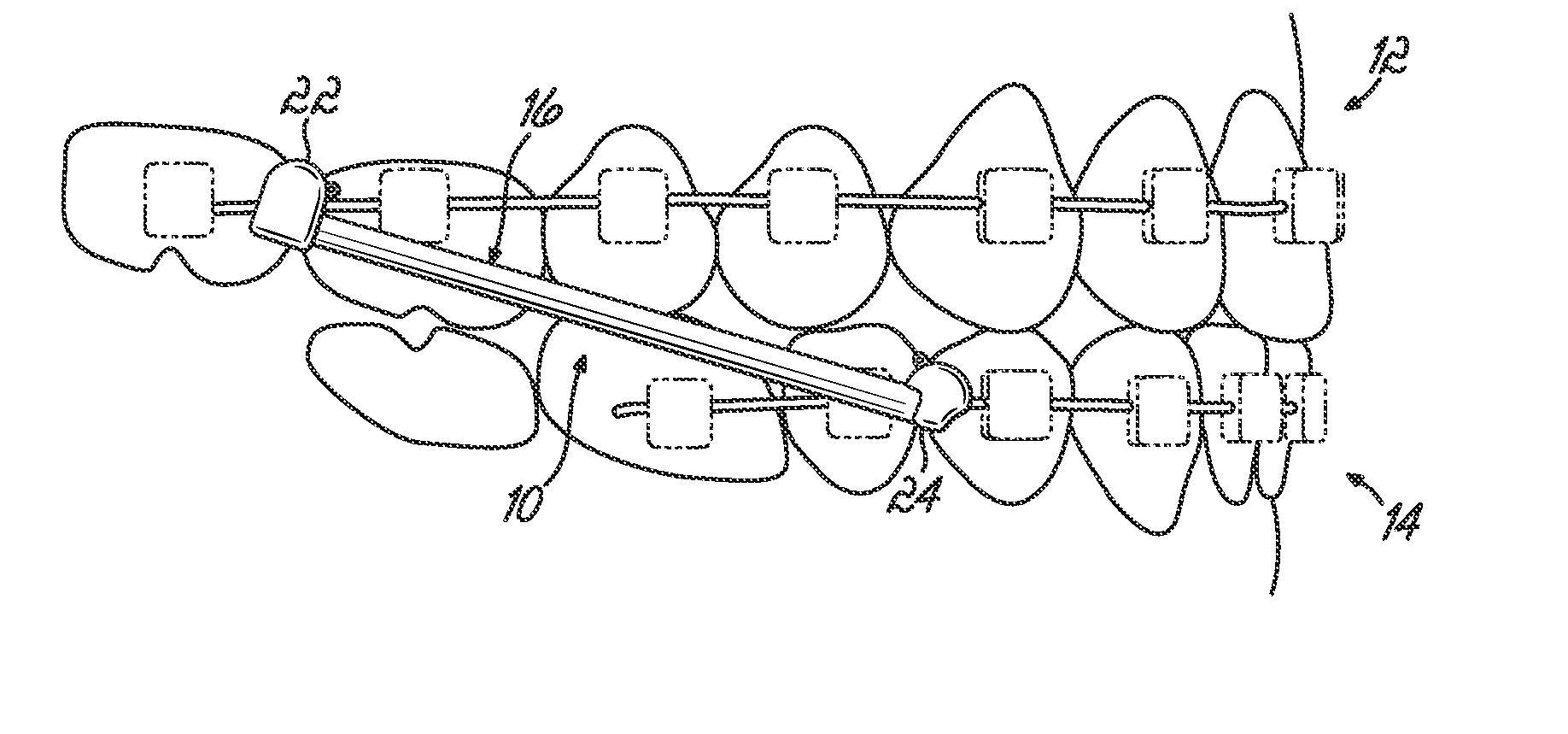 Orthodontic device and method for treating malocclusions