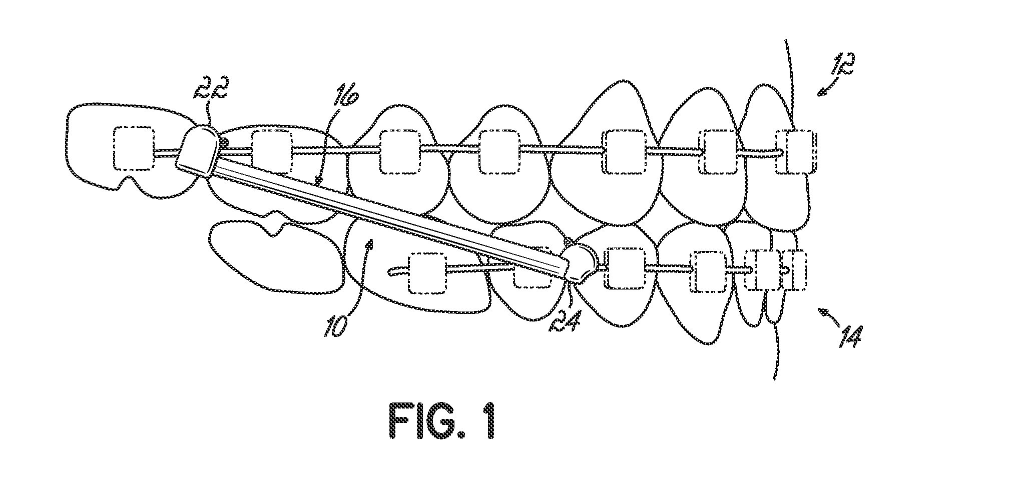 Orthodontic device and method for treating malocclusions