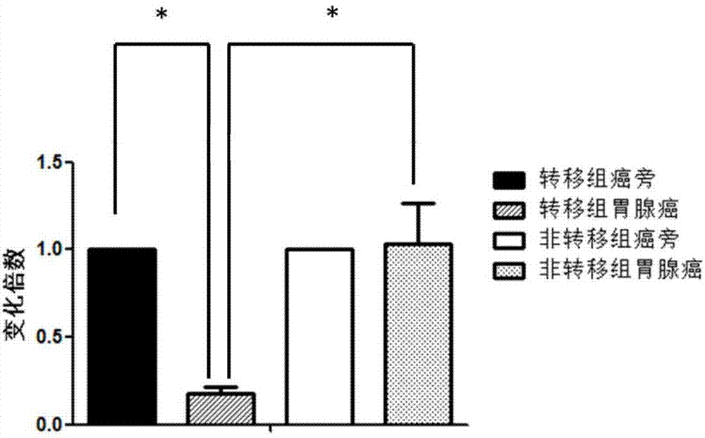 Molecular marker related to gastric adenocarcinoma metastasis