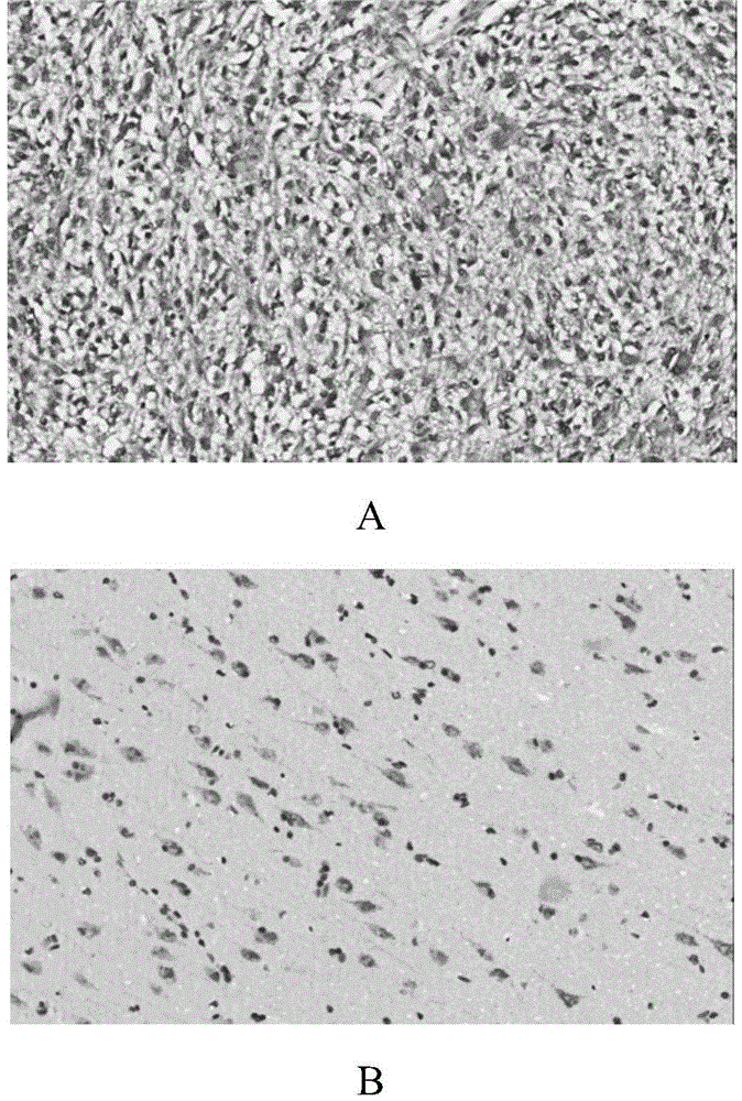 Application of SAMSN1 protein in preparation of glioblastoma prognosis evaluation reagent or kit