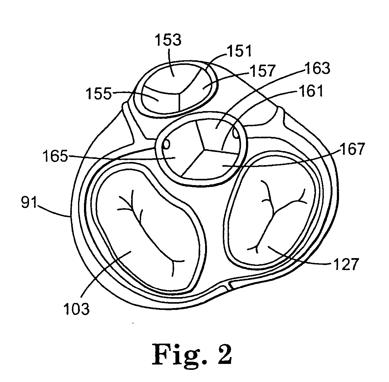 Valve treatment catheter and methods