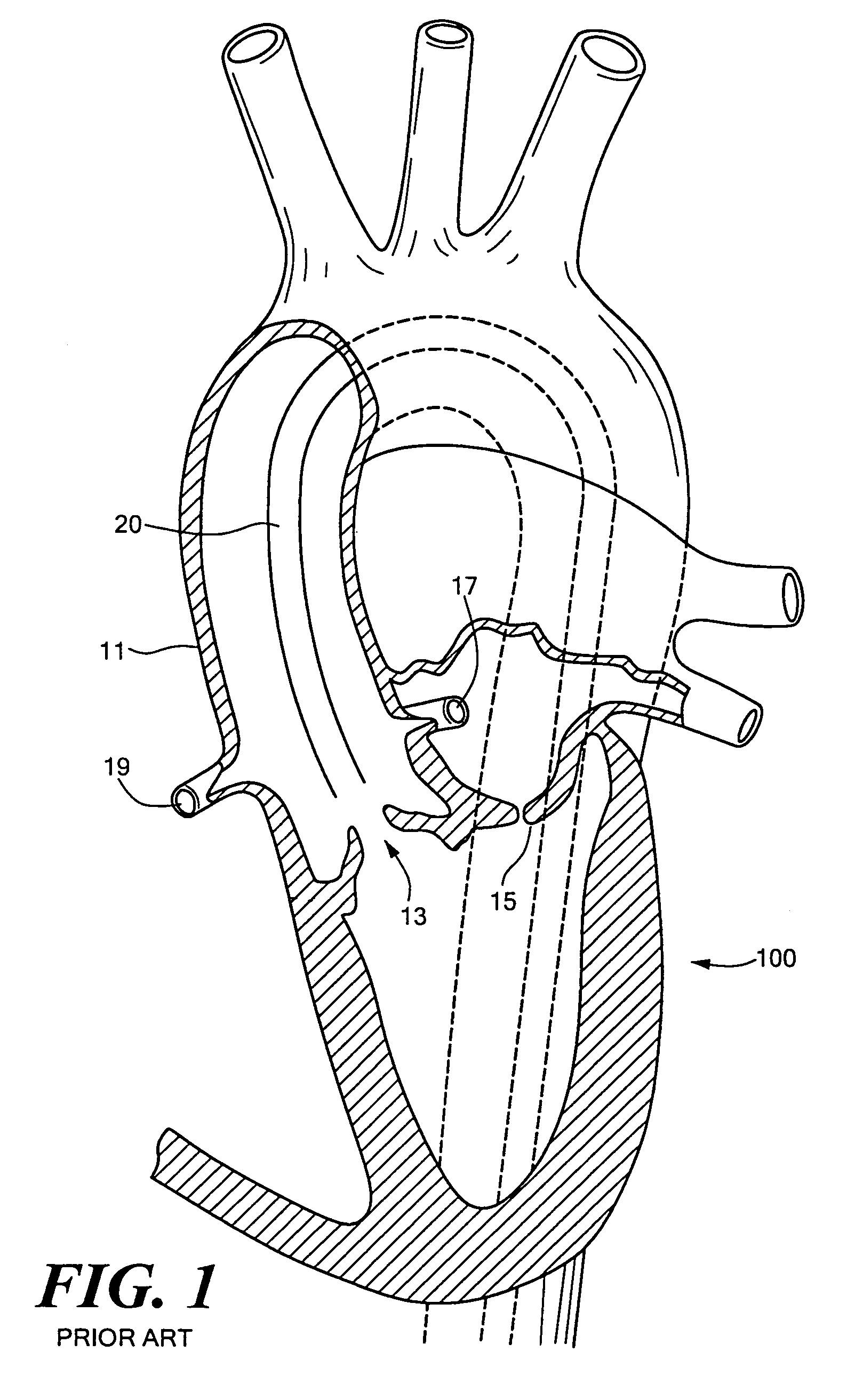 Replacement heart valve sizing device