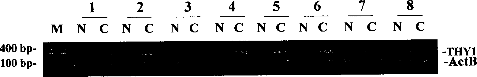 Method of external assistant identifying intestinal-type gastric cancer and differentiation degree thereof and special reagent case