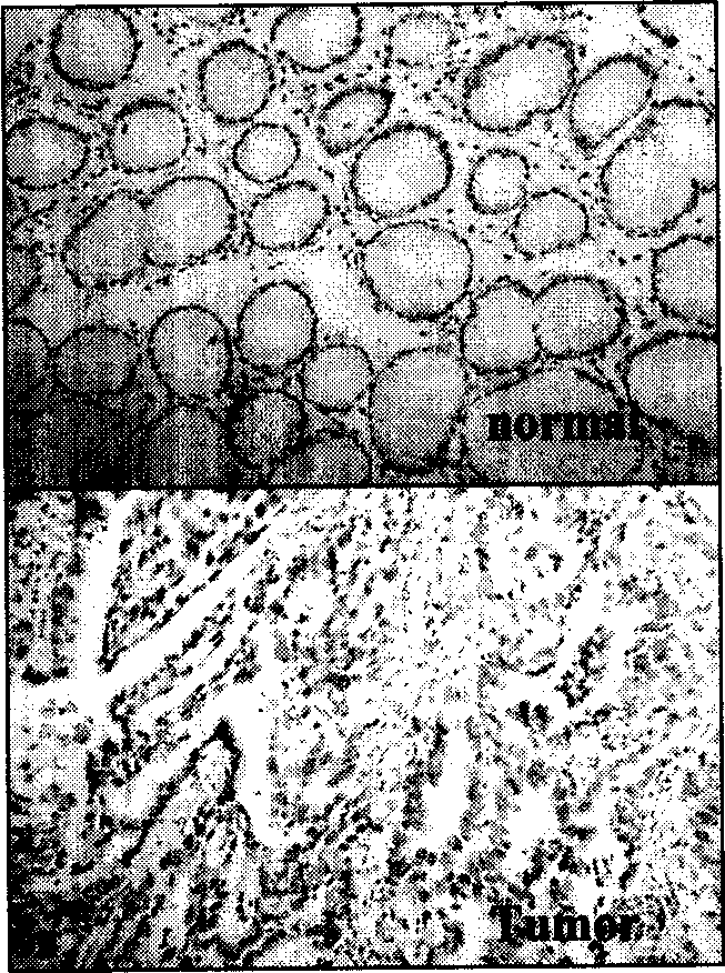 Method of external assistant identifying intestinal-type gastric cancer and differentiation degree thereof and special reagent case