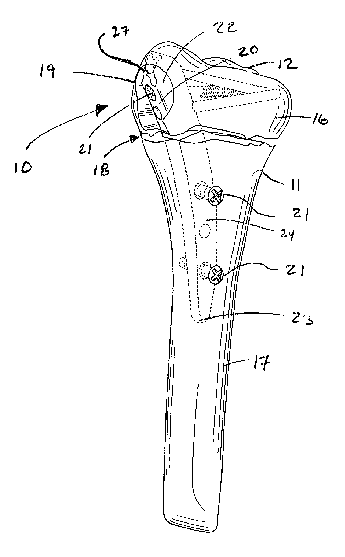 Intramedullary fixation assembly and devices and methods for installing the same