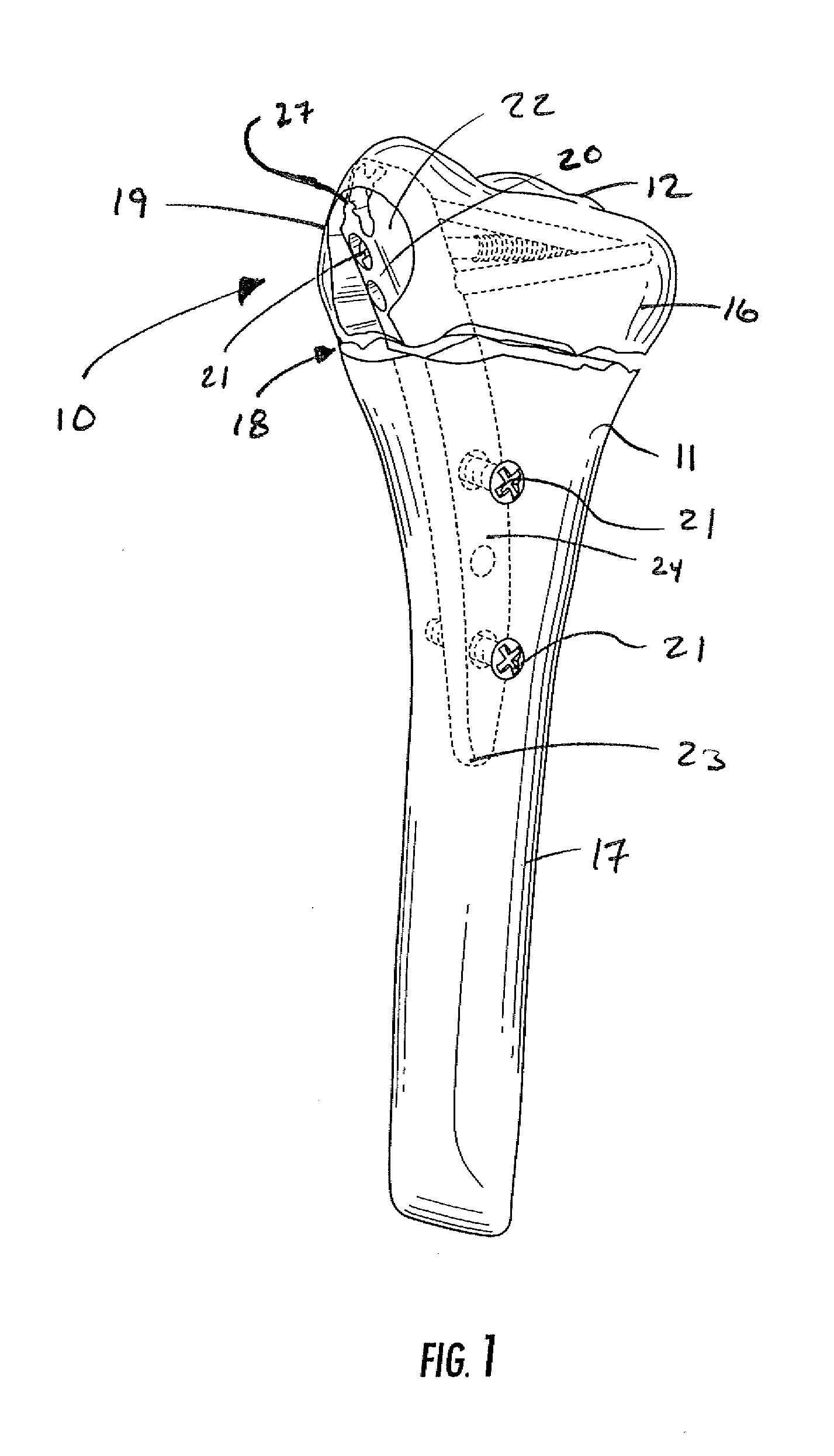 Intramedullary fixation assembly and devices and methods for installing the same