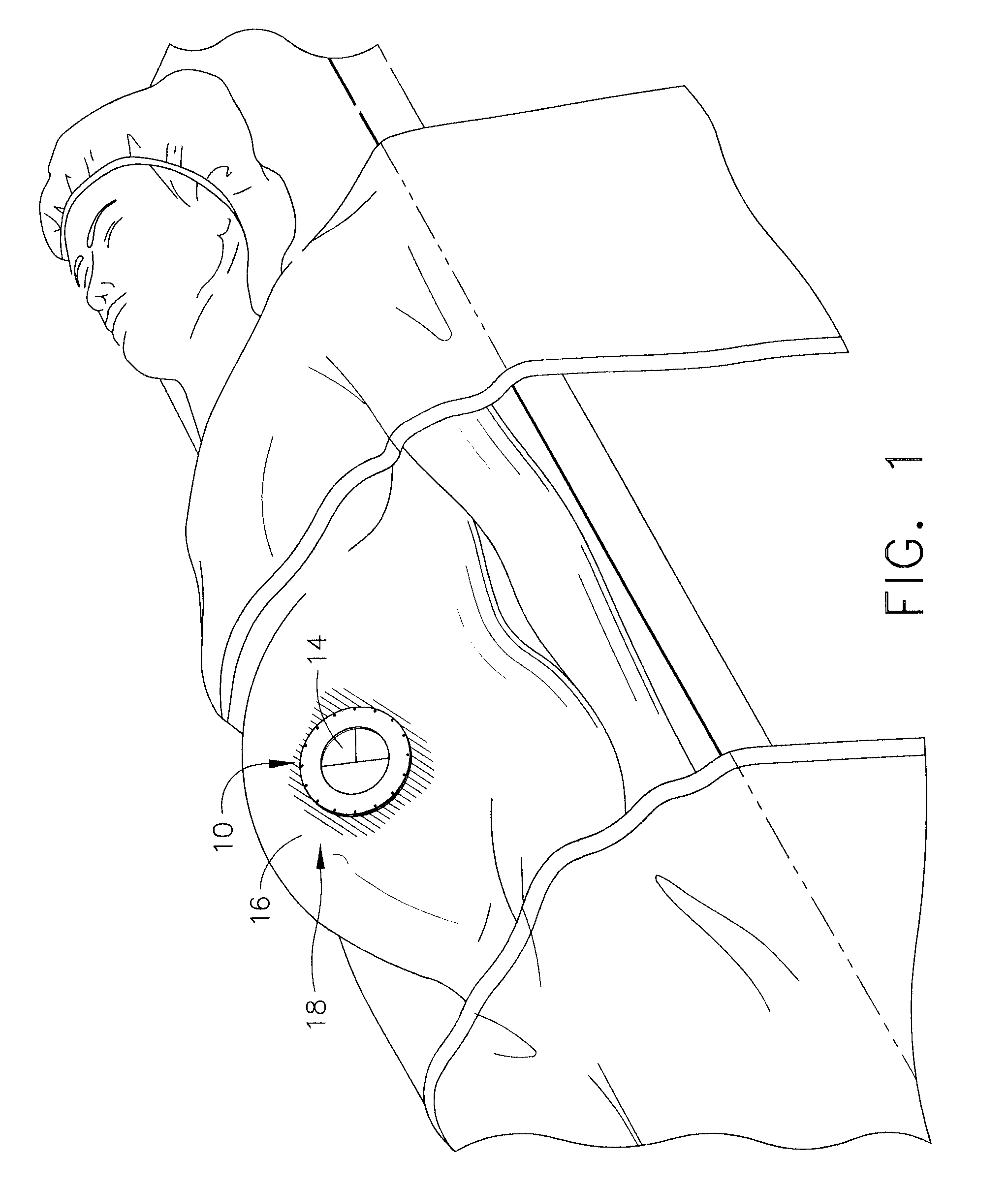 Handoscopy Interwoven Layered Seal Laparoscopic Disk