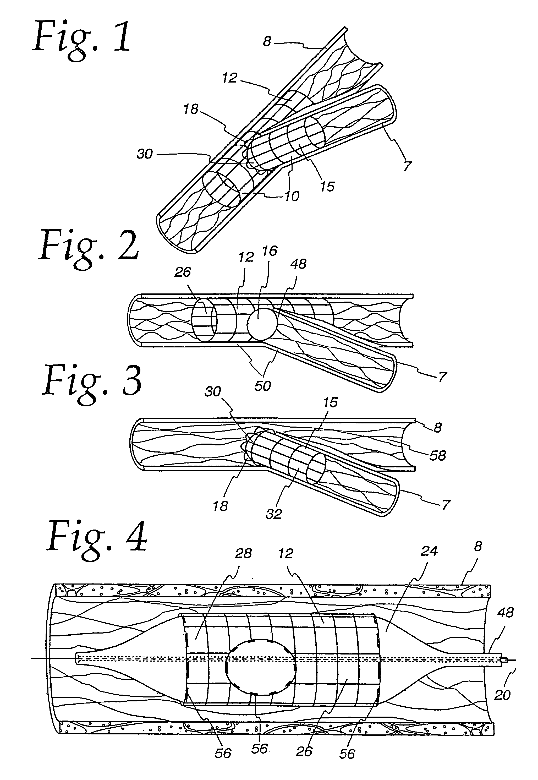 Extendible stent apparatus