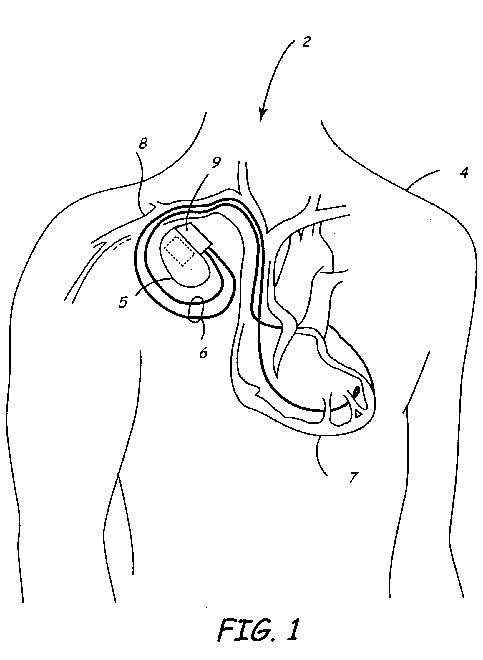 Medical lead and lead connector system