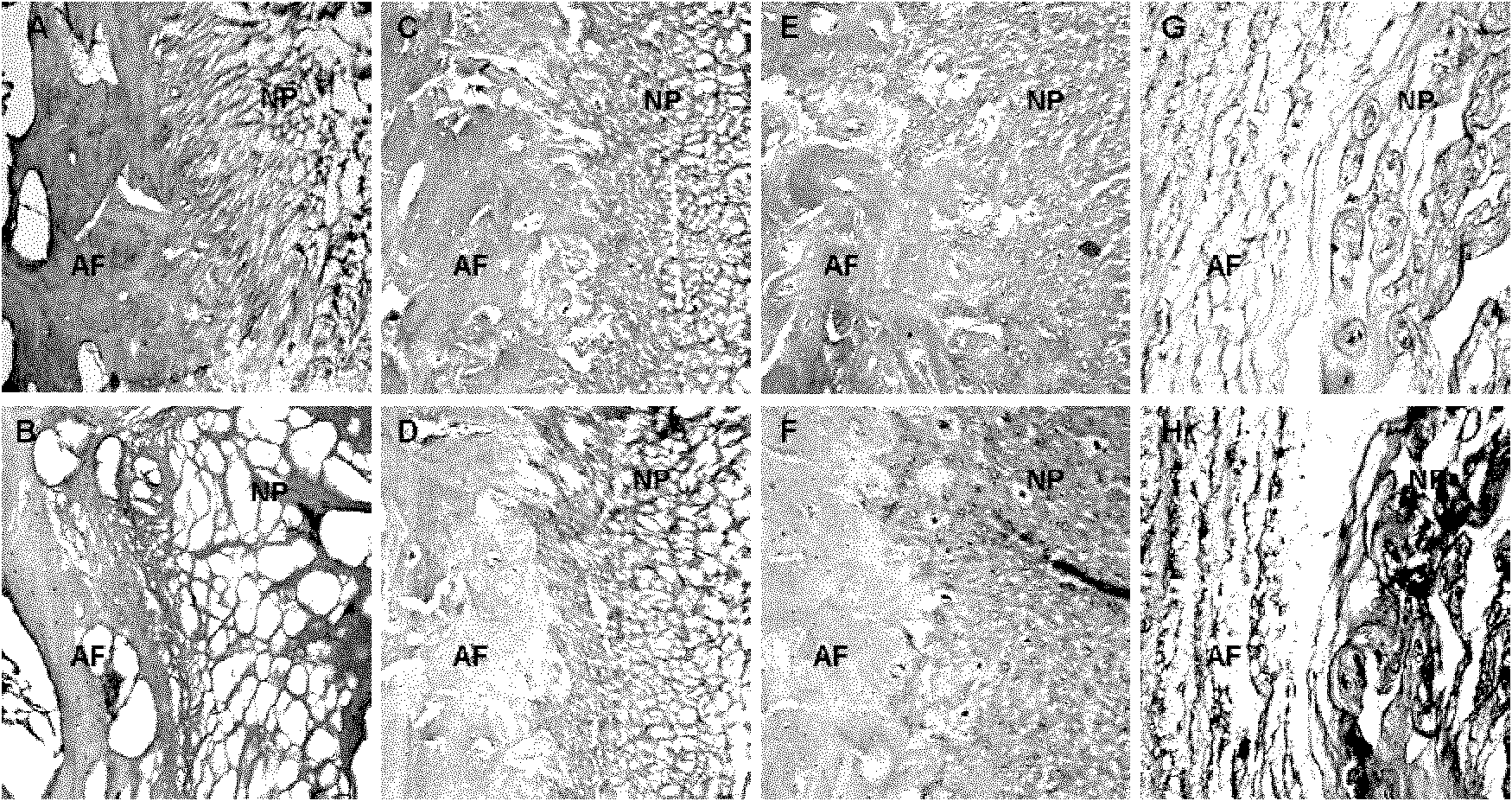 Artificial intervertebral disc complex tissue and preparation method thereof