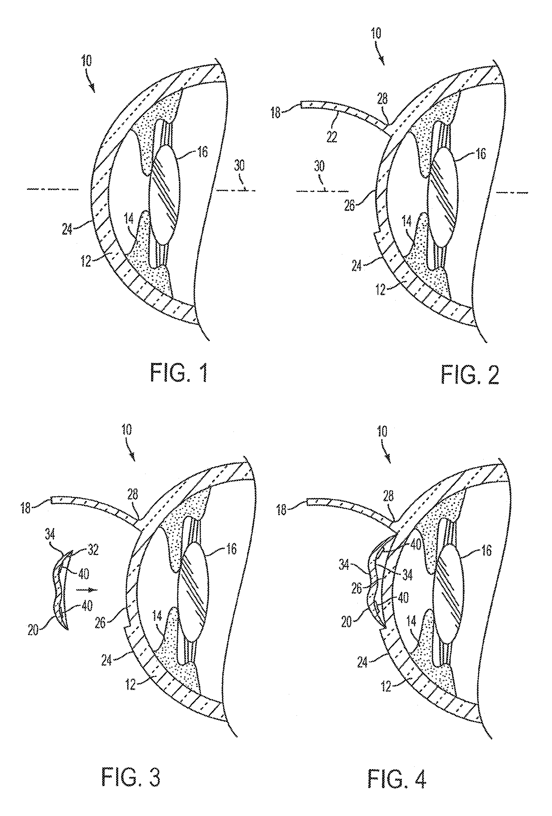 Method of altering the refractive properties of an eye