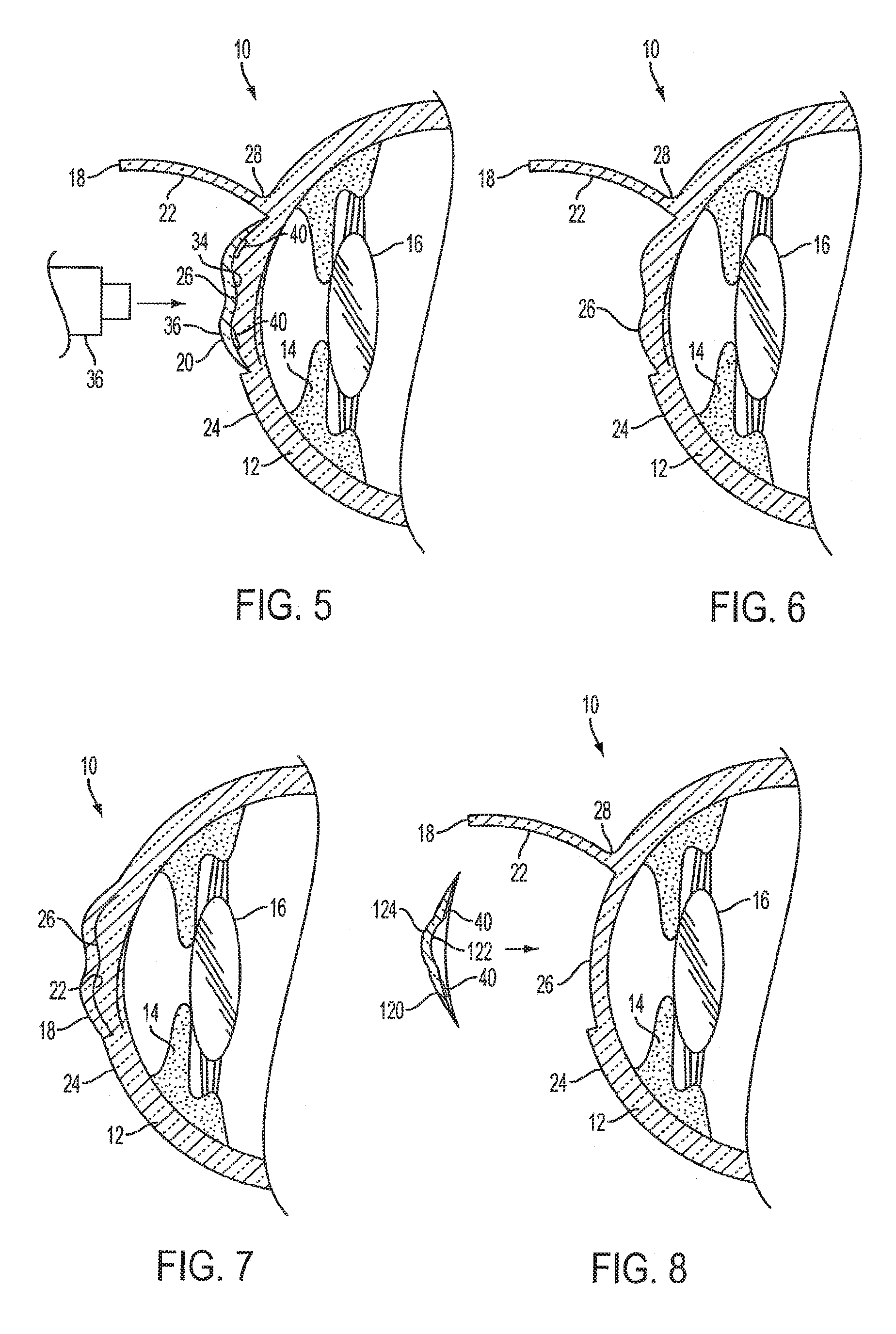 Method of altering the refractive properties of an eye