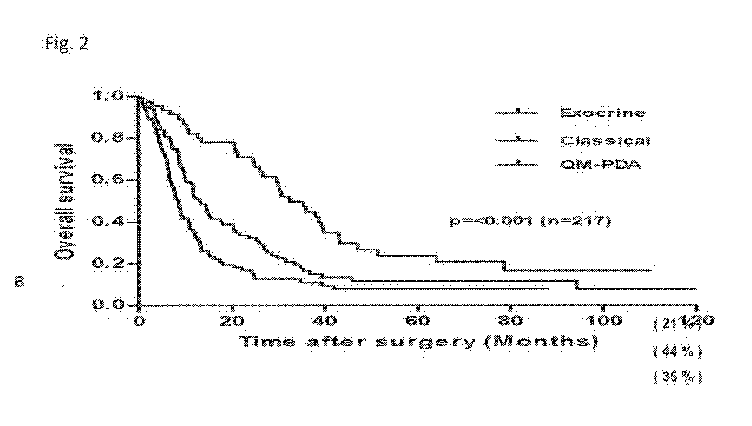 Novel biomarkers for sub-typing pancreatic ductal adenocarcinoma