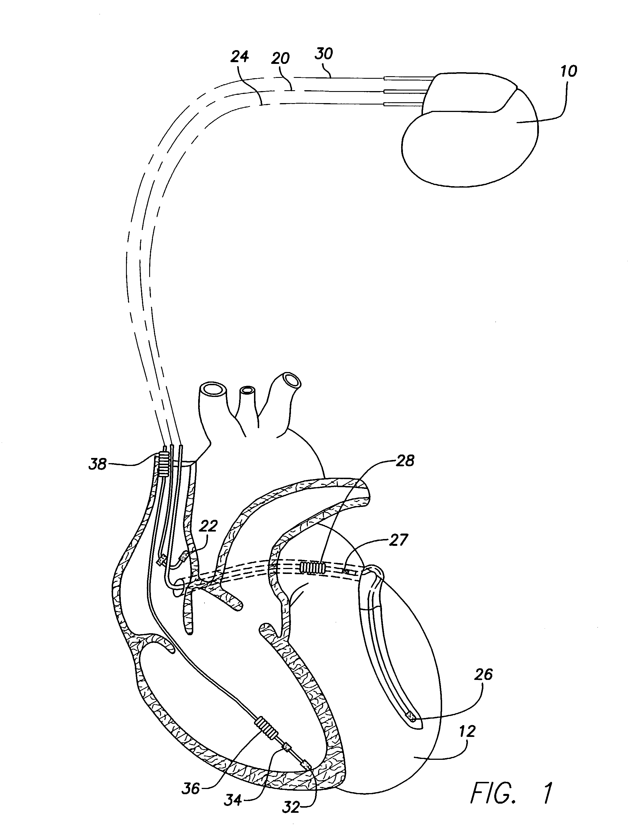 System and method for determining patient posture based on 3-D trajectory using an implantable medical device