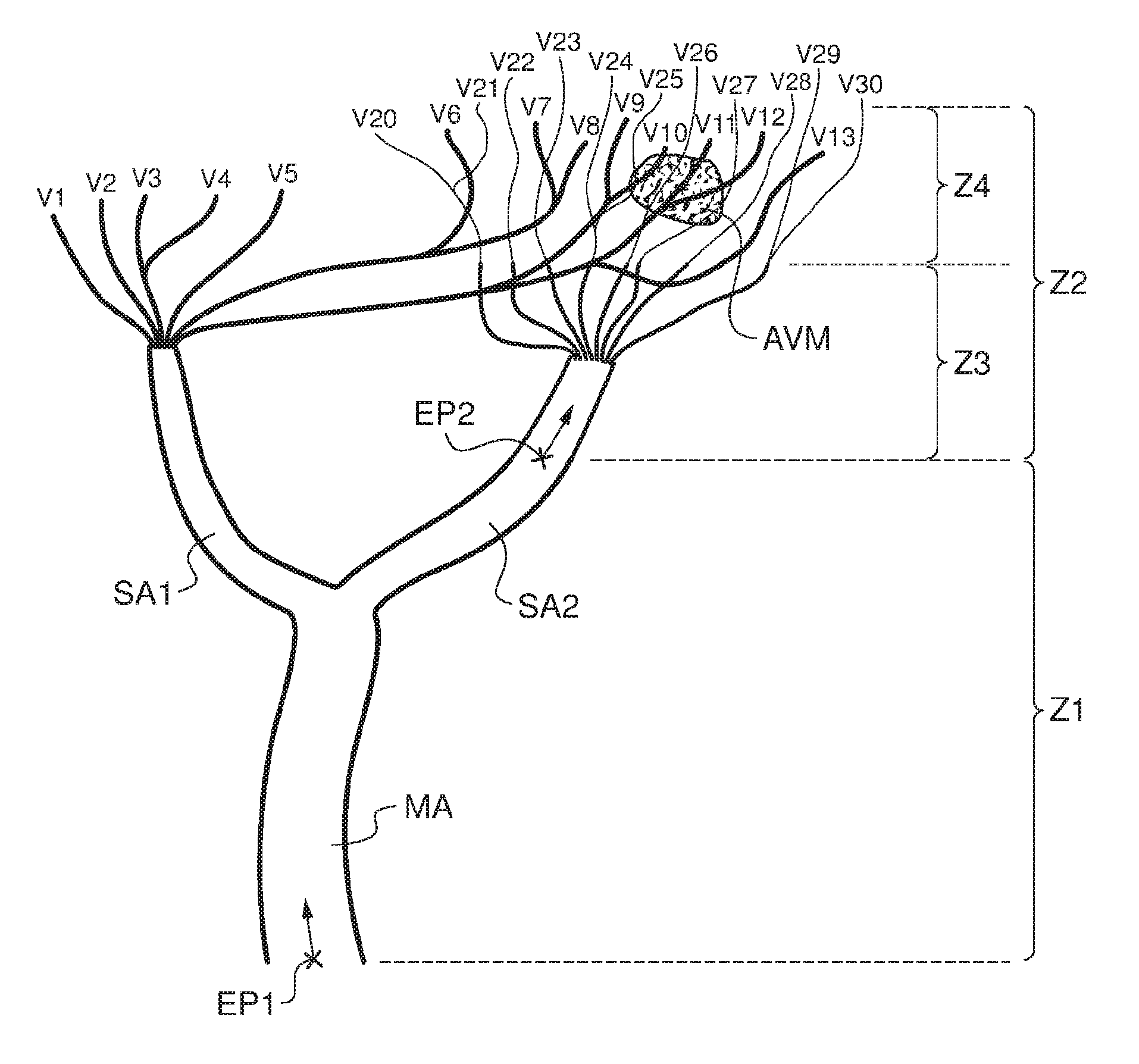 Three dimensional imaging method of a limited zone of a patient's vasculature