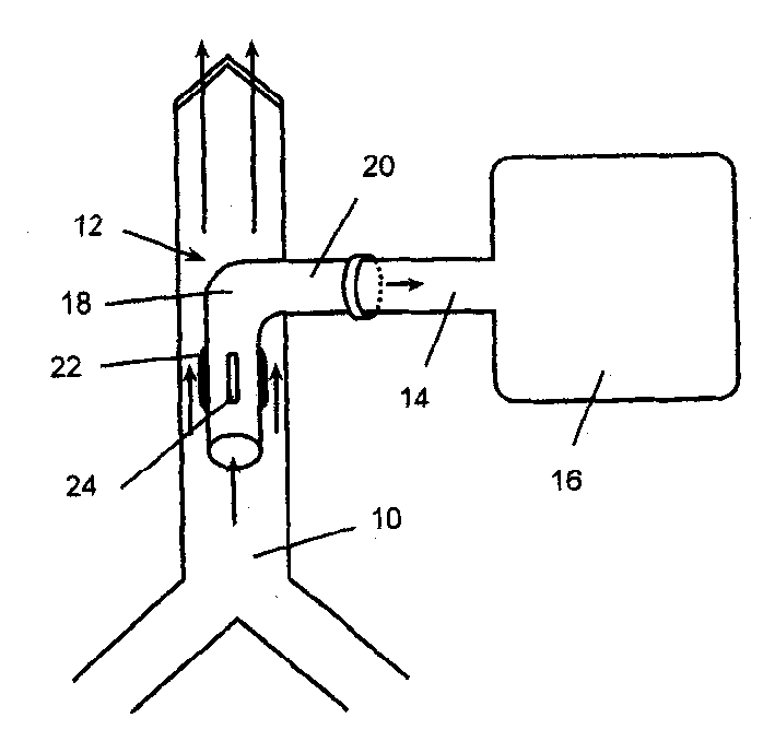 Tracheostomy tube