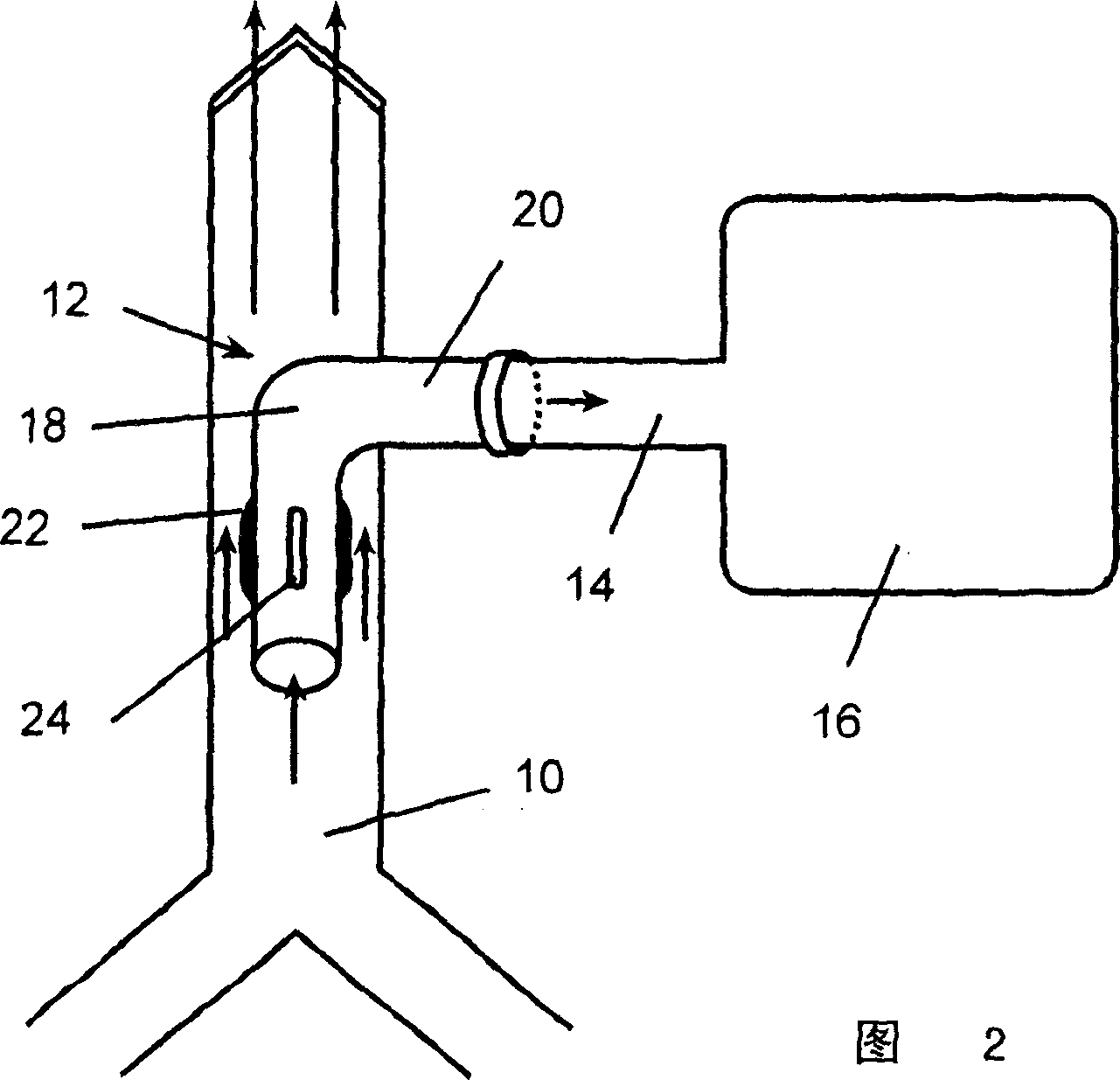 Tracheostomy tube