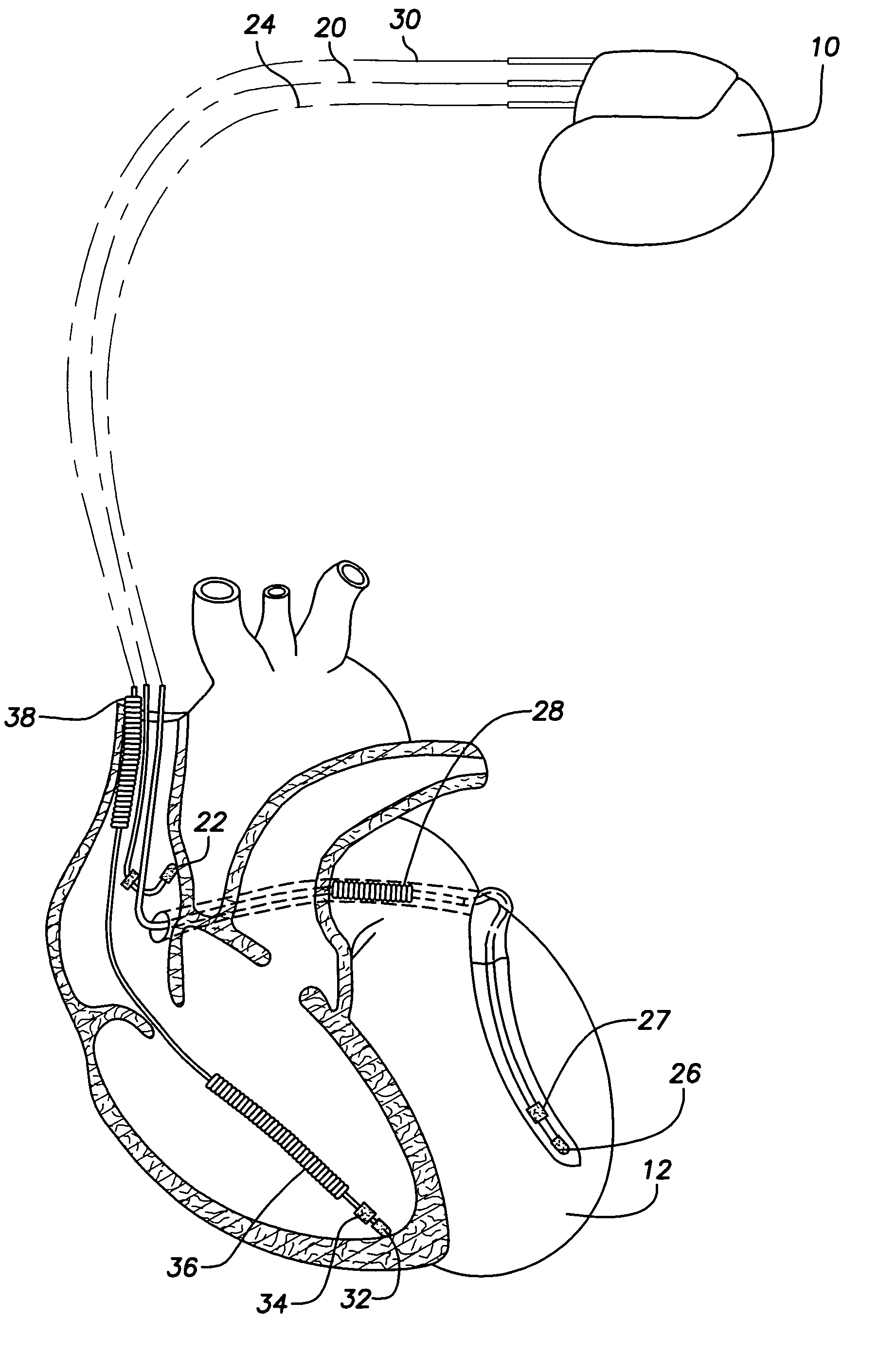 Implantable cardiac stimulation device providing accelerated defibrillation delivery and method