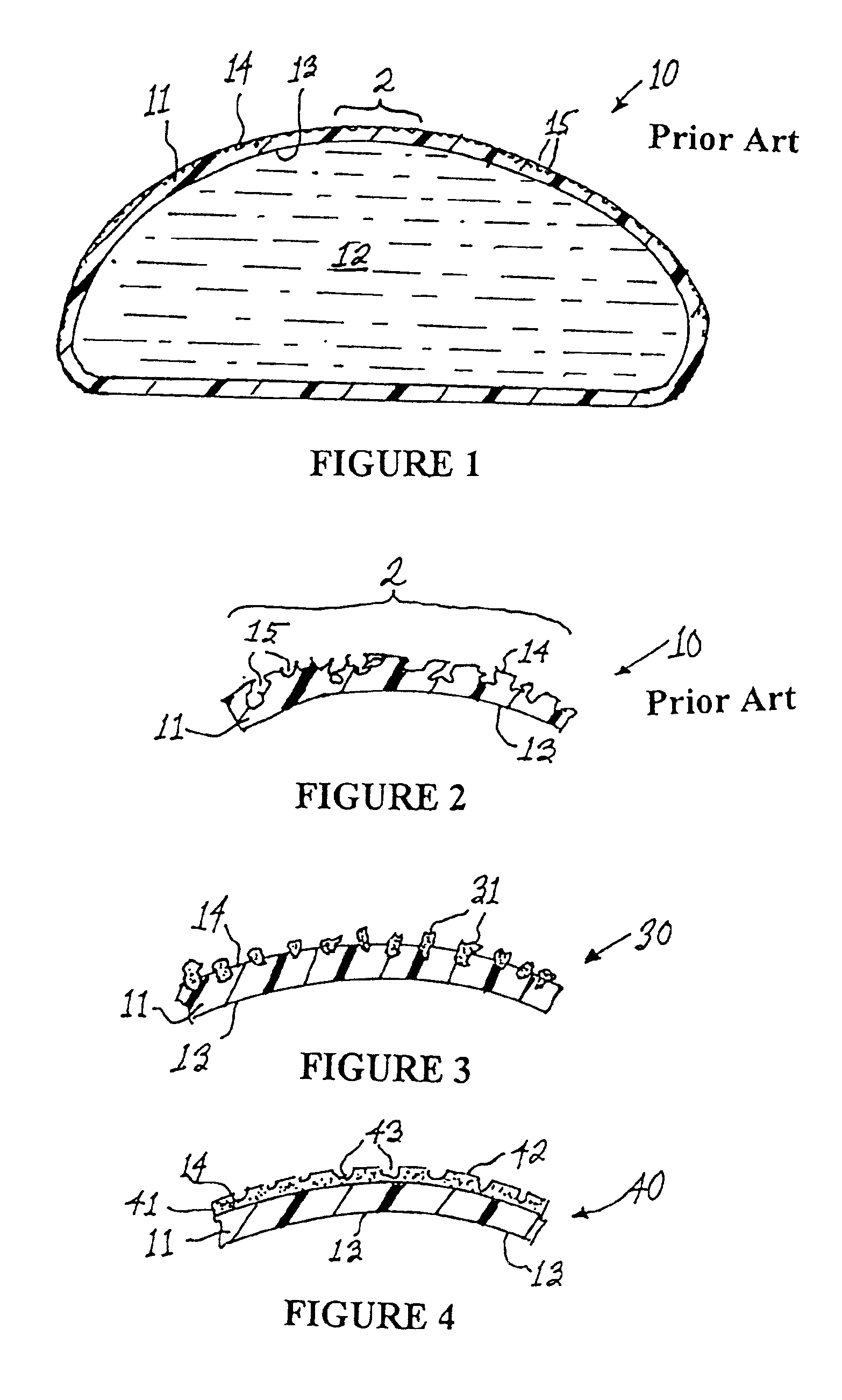 Medical implant having bioabsorbable textured surface