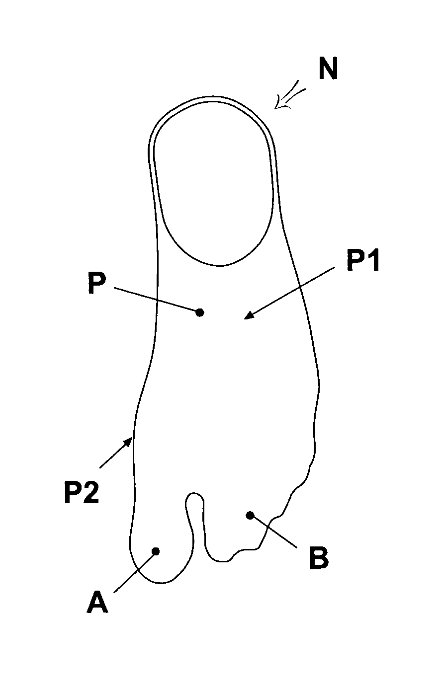 Reinforced stocking or sock for the prevention and/or treatment of hallux valgus