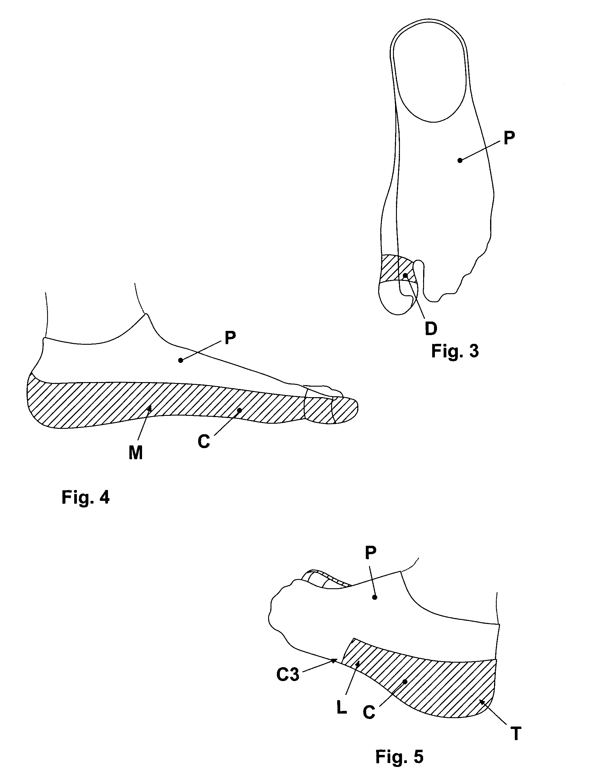 Reinforced stocking or sock for the prevention and/or treatment of hallux valgus