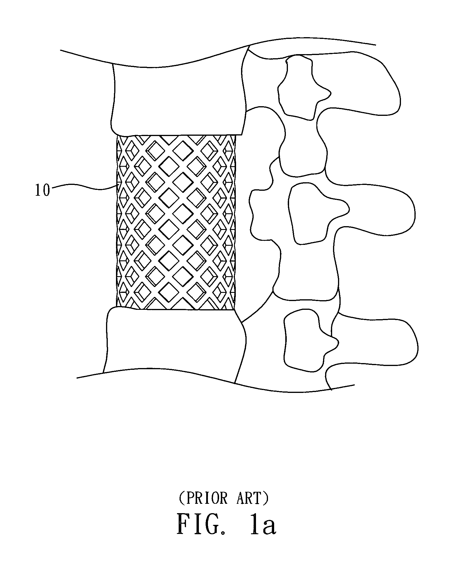 Adjustable vertebral spacer for artificial vertebrae